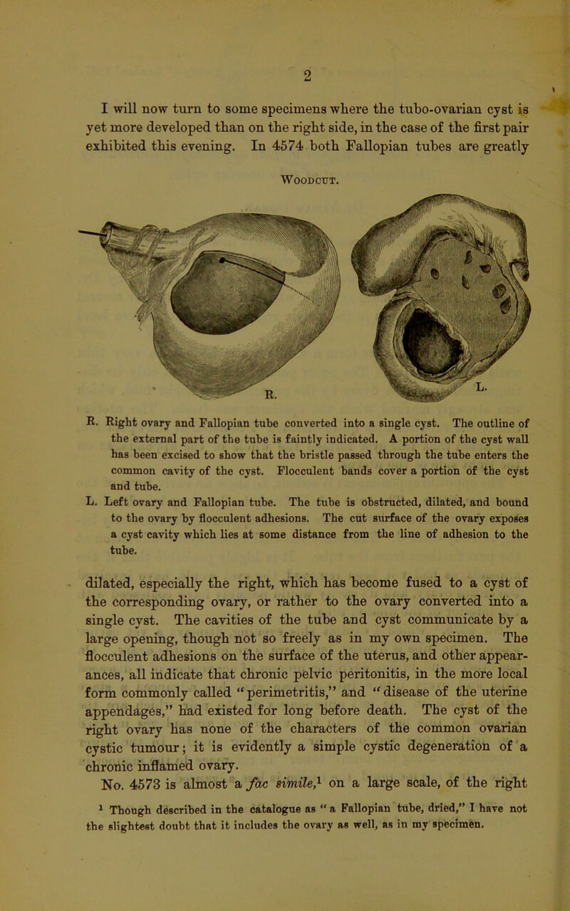 2 I will now turn to some specimens where the tubo-ovarian cyst is yet more developed than on the right side, in the case of the first pair exhibited this evening. In 4574 both Fallopian tubes are greatly Woodcut. R. Right ovary and Fallopian tube converted into a single cyst. The outline of the external part of the tube is faintly indicated. A portion of the cyst wall has been excised to show that the bristle passed through the tube enters the common cavity of the cyst. Flocculent bands cover a portion of the cyst and tube. L. Left ovary and Fallopian tube. The tube is obstructed, dilated, and bound to the ovary by flocculent adhesions. The cut surface of the ovary exposes a cyst cavity which lies at some distance from the line of adhesion to the tube. dilated, especially the right, which has become fused to a cyst of the corresponding ovary, or rather to the ovary converted into a single cyst. The cavities of the tube and cyst communicate by a large opening, though not so freely as in my own specimen. The flocculent adhesions on the surface of the uterus, and other appear- ances, all indicate that chronic pelvic peritonitis, in the more local form commonly called “perimetritis,” and “disease of the uterine appendages,” had existed for long before death. The cyst of the right ovary has none of the characters of the common ovarian cystic tumour; it is evidently a simple cystic degeneration of a chronic inflamed ovary. No. 4573 is almost a fac simile,1 on a large scale, of the right 1 Though described in the catalogue as “ a Fallopian tube, dried,” I have not the slightest doubt that it includes the ovary as well, as in my specimen.