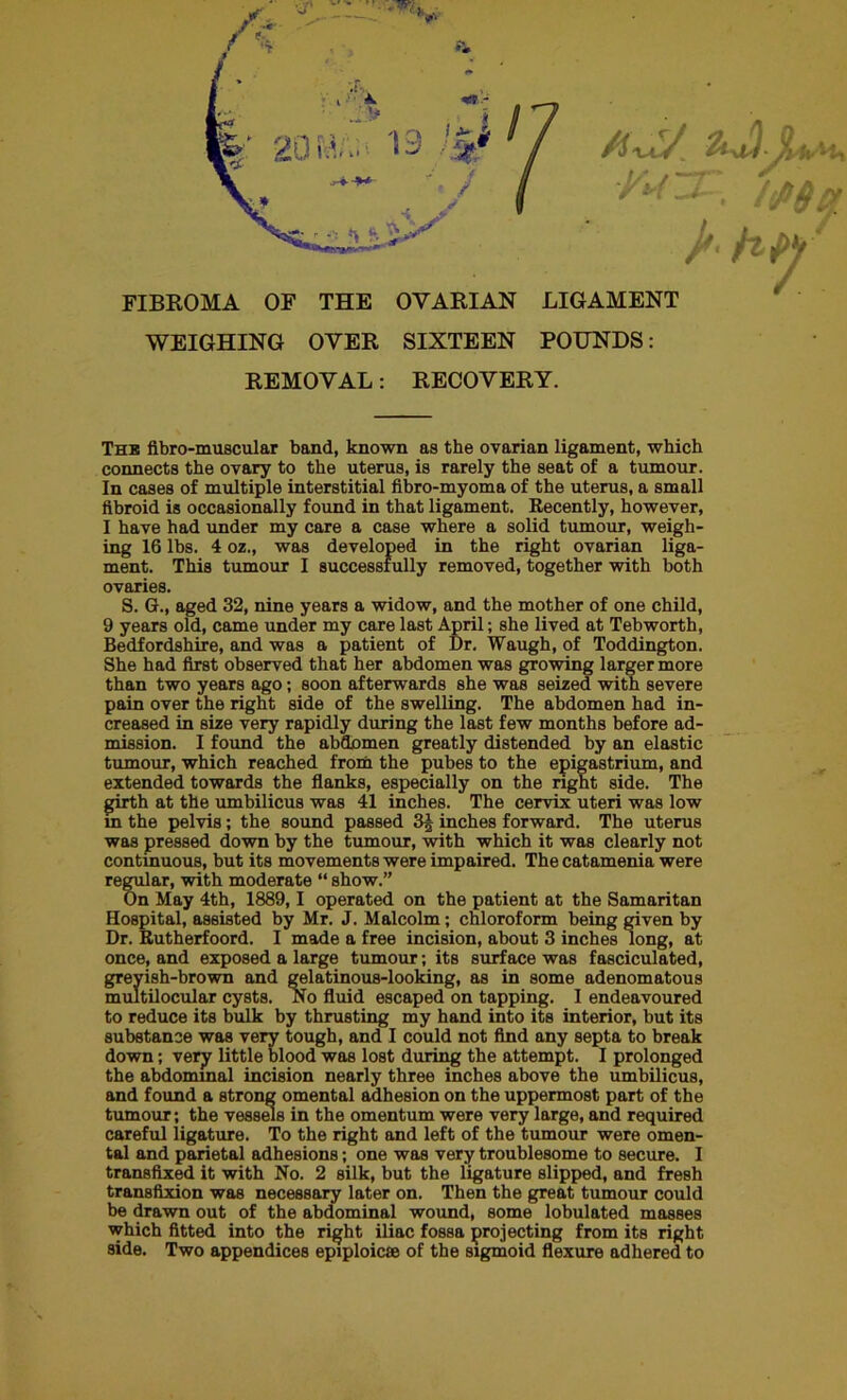 s t'fZl , {(PQh Jt* flinty FIBROMA OF THE OVARIAN LIGAMENT WEIGHING OVER SIXTEEN POUNDS: REMOVAL: RECOVERY. Thb fibro-muscular band, known as the ovarian ligament, which connects the ovary to the uterus, is rarely the seat of a tumour. In cases of multiple interstitial fibro-myoma of the uterus, a small fibroid is occasionally found in that ligament. Recently, however, I have had under my care a case where a solid tumour, weigh- ing 16 lbs. 4 02., was developed in the right ovarian liga- ment. This tumour I successfully removed, together with both ovaries. S. G., aged 32, nine years a widow, and the mother of one child, 9 years old, came under my care last April; she lived at Tebworth, Bedfordshire, and was a patient of Dr. Waugh, of Toddington. She had first observed that her abdomen was growing larger more than two years ago; soon afterwards she was seized with severe pain over the right side of the swelling. The abdomen had in- creased in size very rapidly during the last few months before ad- mission. I found the abdomen greatly distended by an elastic tumour, which reached from the pubes to the epigastrium, and extended towards the flanks, especially on the right side. The girth at the umbilicus was 41 inches. The cervix uteri was low in the pelvis; the sound passed 3^ inches forward. The uterus was pressed down by the tumour, with which it was clearly not continuous, but its movements were impaired. The catamenia were regular, with moderate “ show.” On May 4th, 1889,1 operated on the patient at the Samaritan Hospital, assisted by Mr. J. Malcolm; chloroform being given by Dr. Rutherfoord. I made a free incision, about 3 inches long, at once, and exposed a large tumour; its surface was fasciculated, greyish-brown and gelatinous-looking, as in some adenomatous multilocular cysts. No fluid escaped on tapping. 1 endeavoured to reduce its bulk by thrusting my hand into its interior, but its substance was very tough, and I could not find any septa to break down; very little blood was lost during the attempt. I prolonged the abdominal incision nearly three inches above the umbilicus, and found a strong omental adhesion on the uppermost part of the tumour; the vessels in the omentum were very large, and required careful ligature. To the right and left of the tumour were omen- tal and parietal adhesions; one was very troublesome to secure. I transfixed it with No. 2 silk, but the ligature slipped, and fresh transfixion was necessary later on. Then the great tumour could be drawn out of the abdominal wound, some lobulated masses which fitted into the right iliac fossa projecting from its right side. Two appendices epiploic® of the sigmoid flexure adhered to