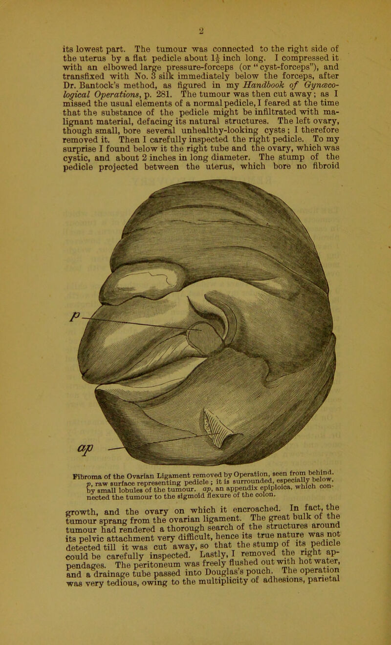 its lowest part. The tumour was connected to the right side of the uterus by a flat pedicle about I5 inch long. I compressed it with an elbowed large pressure-forceps (or “ cyst-forceps”), and transfixed with No. 3 silk immediately below the forceps, after Dr. Bantock’s method, as figured in my Handbook of Gyneeco- loyical Operations, p. 281. The tumour was then cut away; as I missed the usual elements of a normal pedicle, I feared at the time that the substance of the pedicle might be infiltrated with ma- lignant material, defacing its natural structures. The left ovary, though small, bore several unhealthy-looking cysts ; I therefore removed it. Then I carefully inspected the right pedicle. To my surprise I found below it the right tube and the ovary, which was cystic, and about 2 inches in long diameter. The stump of the pedicle projected between the uterus, which bore no fibroid Fibroma of the Ovarian Ligament removed by Operation, seen from p, raw surface representing pedicle ; it is surrounded especia y e^w. by small lobules of the tumour, ap, an appendix epiploica, which con nected the tumour to the sigmoid flexure of the colon. growth, and the ovary on which it encroached. La_ fact, the tumour sprang from the ovarian ligament. The great bulk of the tumour had rendered a thorough search of the structures around its pelvic attachment very difficult, hence its true nature was not detected till it was cut away, so that the stump of its pedicle could be carefully inspected. Lastly, I removed the right ap- pendages. The peritoneum was freely flushed out with hot water, and a drainage tube passed into Douglas s pouch. The opera ,ion was very tedious, owing to the multiplicity of adhesions, parietal