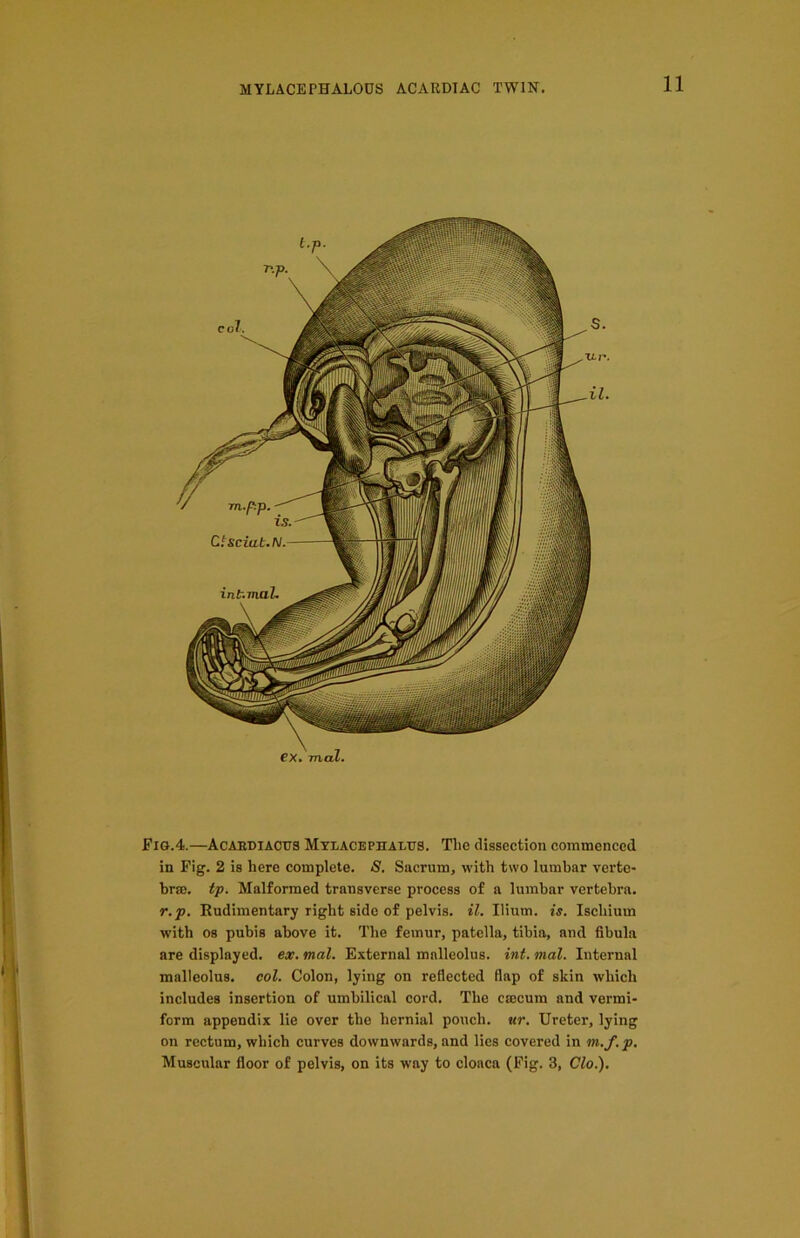 Fig.4.—Acabdiactjs Mylacephaltjs. The dissection commenced in Fig. 2 is here complete. S. Sacrum, with two lumbar verte- brae. tp. Malformed transverse process of a lumbar vertebra. r.p. Rudimentary right side of pelvis, il. Ilium, is. Ischium with os pubis above it. The femur, patella, tibia, and fibula are displayed, ex. mal. External malleolus, int. mal. Internal malleolus, col. Colon, lying on reflected flap of skin which includes insertion of umbilical cord. The caecum and vermi- form appendix lie over the hernial pouch, ur. Ureter, lying on rectum, which curves downwards, and lies covered in m./.p. Muscular floor of pelvis, on its way to cloaca (Fig. 3, Clo.).