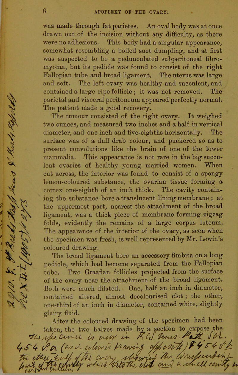 6 was made through fat parietes. An oval body was at once drawn out of the incision without any difficulty, as there were no adhesions. This body had a singular appearance, somewhat resembling a boiled suet dumpling, and at first was suspected to be a pedunculated subperitoneal fibro- myoma, but its pedicle was found to consist of the right Fallopian tube and broad ligament. The uterus was large and soft. The left ovary was healthy and succulent, and contained a large ripe follicle ; it was not removed. The parietal and visceral peritoneum appeared perfectly normal. The patient made a good recovery. The tumour consisted of the right ovary. It weighed two ounces, and measured two inches and a half in vertical diameter, and one inch and five-eighths horizontally. The surface was of a dull drab colour, and puckered so as to present convolutions like the brain of one of the lower mammalia. This appearance is not rare in the big succu- lent ovaries of healthy young married women. When cut across, the interior was found to consist of a spongy lemon-coloured substance, the ovarian tissue forming a cortex one-eighth of an inch thick. The cavity contain- ing the substance bore a translucent lining membrane ; at the uppermost part, nearest the attachment of the broad ligament, was a thick piece of membrane forming zigzag folds, evidently the remains of a large corpus luteum. The appearance of the interior of the ovary, as seen when the specimen was fresh, is well represented by Mr. Lewin's coloured drawing. The broad ligament bore an accessory fimbria on a long pedicle, which had become separated from the Fallopian tube. Two Graafian follicles projected from the surface of the ovary near the attachment of the broad ligament. contained altered, almost decolourised clot; the other, one-third of an inch in diameter, contained white, slightly glairy fluid. After the coloured drawing of the specimen had been taken, the two halves made bv a section to expose the r/Li U Cd PU4T A C<J. fowi/) - S'M- * fat blfcujjyl* y Vjfcl