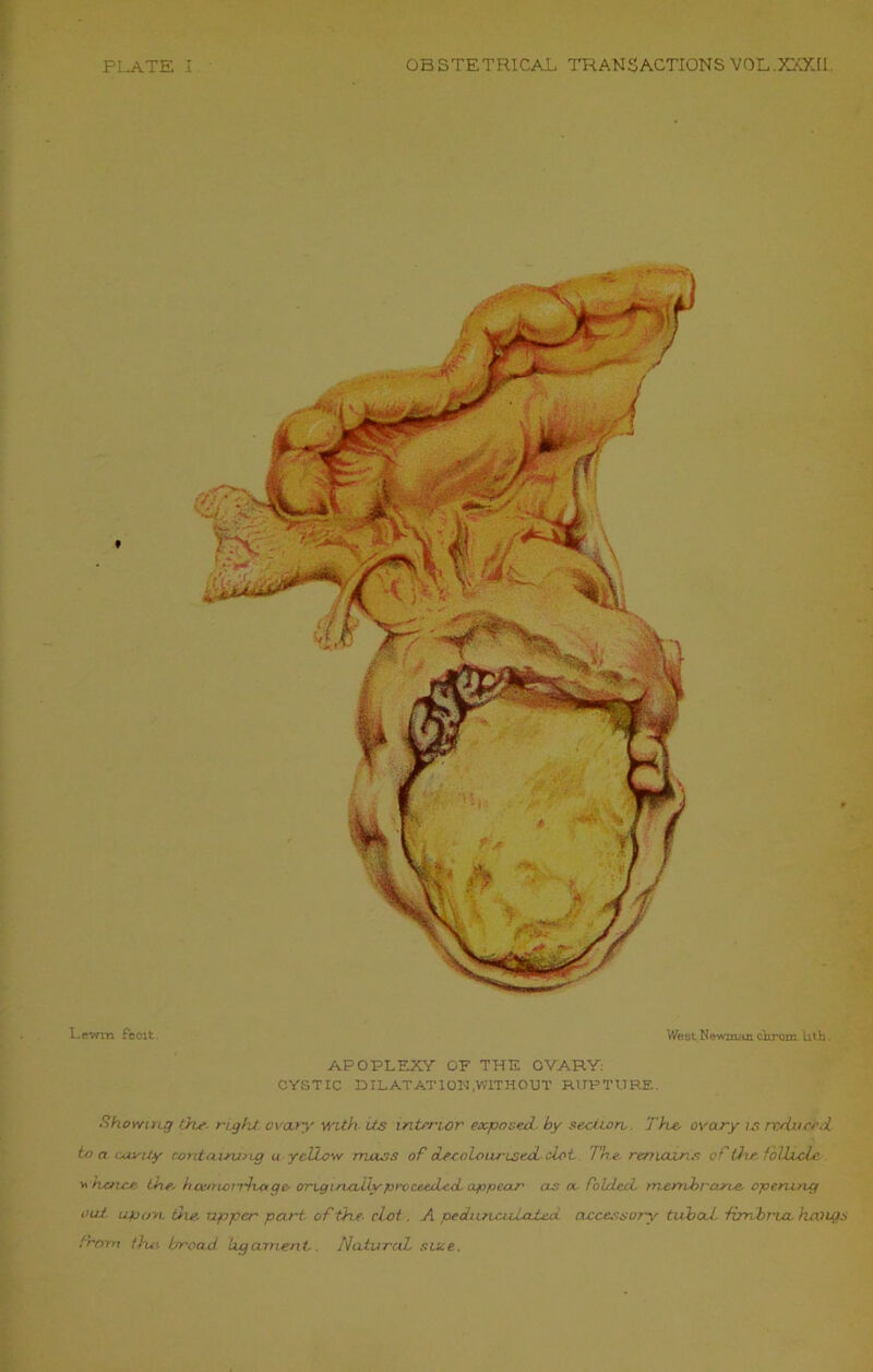 PLATE I OBSTETRICAL TRANSACTIONS VOL.XXXII. Levan Fecit a West Newmirn ckrom Utb. APOPLEXY OF THE OVARY: CYSTIC DILATATION,WITHOUT RUPTURE. Showing the. right ovary with Us interior exposed, by section,. The, ovary is reduced, to a county curtaining u yellow mass of decolourised clot The. remoans of ihe follicle, whence, the, h cemctrlux g t> originally proceeded, appear as a. folded, membrane, opening out upon the, upper part of the. clot. A pedunculated accessory tubal fimbria, hangs from the, broad ligament. Natural sine.