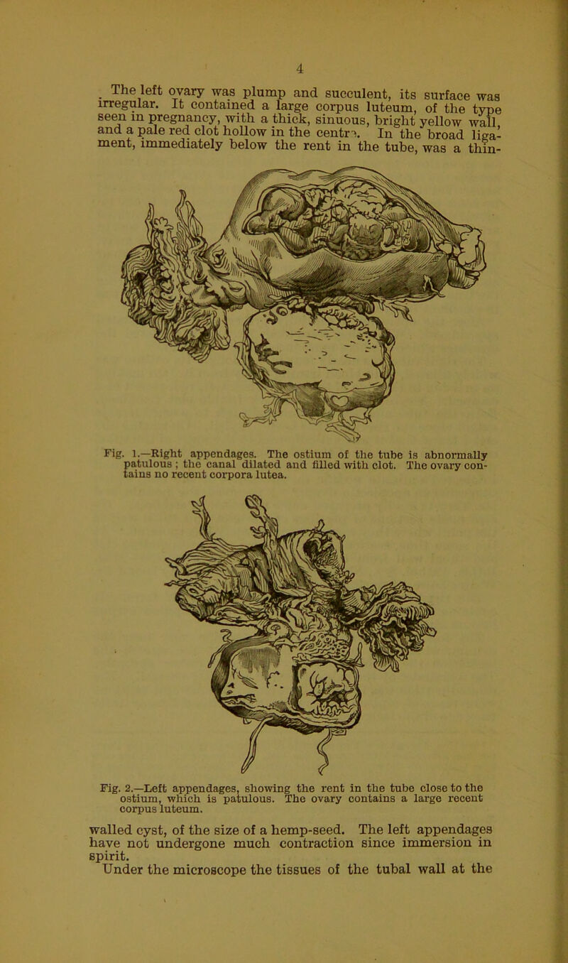 The left ovary was plump and succulent, its surface was irregular. It contained a large corpus luteum, of the type seen in pregnancy, with a thick, sinuous, bright yellow wall and a pale red clot hollow in the centra In the broad liga- ment, immediately below the rent in the tube, was a thin- Fig. 1.—Right appendages. The ostium of the tube is abnormally patulous ; the canal dilated and filled with clot. The ovary con- tains no recent corpora lutea. Fig. 2.—Left appendages, showing the rent in the tube close to the ostium, which is patulous. The ovary contains a large recent corpus luteum. walled cyst, of the size of a hemp-seed. The left appendages have not undergone much contraction since immersion in spirit. Under the microscope the tissues of the tubal wall at the