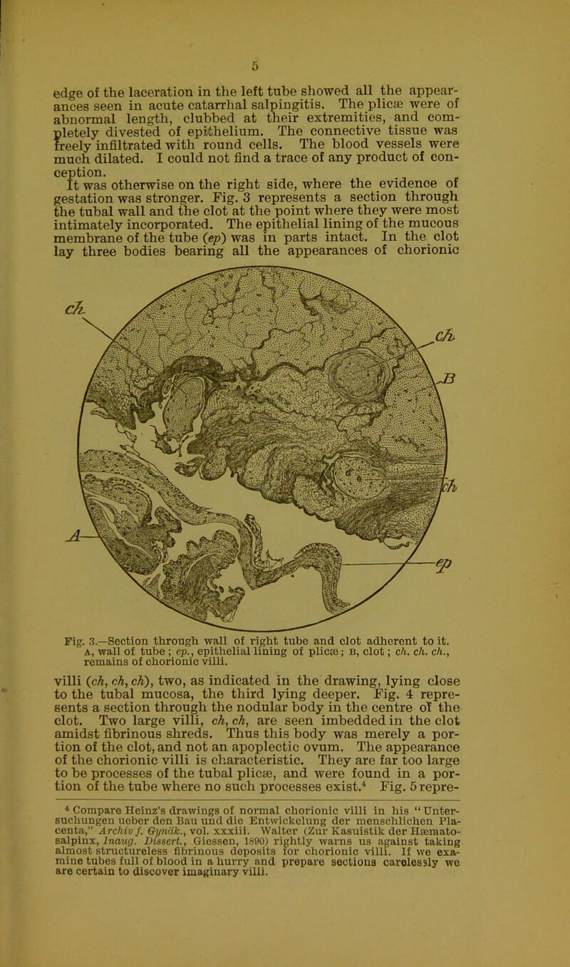 edge of the laceration in the left tube showed all the appear- ances seen in acute catarrhal salpingitis. The plicae were of abnormal length, clubbed at their extremities, and com- pletely divested of epithelium. The connective tissue was freely infiltrated with round cells. The blood vessels were much dilated. I could not find a trace of any product of con- ception. It was otherwise on the right side, where the evidenoe of gestation was stronger. Fig. 3 represents a section through the tubal wall and the clot at the point where they were most intimately incorporated. The epithelial lining of the mucous membrane of the tube (ep) was in parts intact. In the clot lay three bodies bearing all the appearances of chorionic Fig. 3.—Section through wall o£ right tube and clot adherent to it. a, wall of tube ; ep., epithelial lining of plicte; b, clot; eft. eft. eft., remains of chorionic villi. villi (ck, ch,ch), two, as indicated in the drawing, lying close to the tubal mucosa, the third lying deeper. Fig. 4 repre- sents a section through the nodular body in the centre of the clot. Two large villi, ch, ch, are seen imbedded in the clot amidst fibrinous shreds. Thus this body was merely a por- tion of the clot, and not an apoplectic ovum. The appearance of the chorionic villi is characteristic. They are far too large to be processes of the tubal plicae, and were found in a por- tion of the tube where no such processes exist.4 Fig. 5 repre- 4 Compare Heinz’s drawings of normal chorionic villi in his “TJnter- suchungen ueber den Bau und die Entwickclung der menschlichen Pla- centa,” Archivf. Gynak., vol. xxxiii. Walter (Zur Kasuistik der Hremato- salpinx, Inaug. Dissert., Giessen, 1890) rightly warns us against taking almost structureless fibrinous deposits for chorionic villi. If we exa- mine tubes full of blood in a hurry and prepare sections carolessly we are certain to discover imaginary villi.