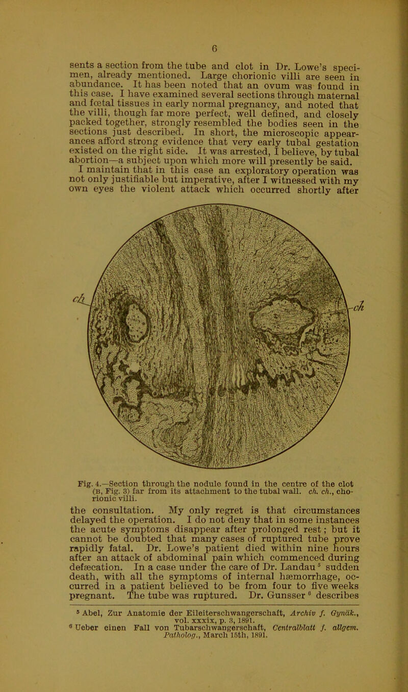 sents a section from the tube and clot in Dr. Lowe’s speci- men, already mentioned. Large chorionic villi are seen in abundance. It has been noted that an ovum was found in this case. I have examined several sections through maternal and foetal tissues in early normal pregnancy, and noted that the villi, though far more perfect, well defined, and closely packed together, strongly resembled the bodies seen in the sections just described. In short, the microscopic appear- ances afford strong evidence that very early tubal gestation existed on the right side. It was arrested, I believe, by tubal abortion—a subject upon which more will presently be said. I maintain that in this case an exploratory operation was not only justifiable but imperative, after I witnessed with my own eyes the violent attack which occurred shortly after Fig. 4.—Section through the nodule found in the centre of the clot (b, Fig. 3) far from its attachment to the tubal wall. ch. ch., cho- rionic villi. the consultation. My only regret is that circumstances delayed the operation. I do not deny that in some instances the acute symptoms disappear after prolonged rest; but it cannot be doubted that many cases of ruptured tube prove rapidly fatal. Dr. Lowe’s patient died within nine hours after an attack of abdominal pain which commenced during defsecation. In a case under the care of Dr. Landau5 sudden death, with all the symptoms of internal haemorrhage, oc- curred in a patient believed to be from four to five weeks pregnant. The tube was ruptured. Dr. Gunsser * * 8 describes 5 Abel, Zur Anatomie der Eileiterschwangerscliaft, Archiv f. Gyndk., vol. xxxix, p. 8,1891. 8 Uebcr einen Fall von Tubarschwangerschaft, Centralblatt f. allgcm. Patholog., March 15th, 1891.