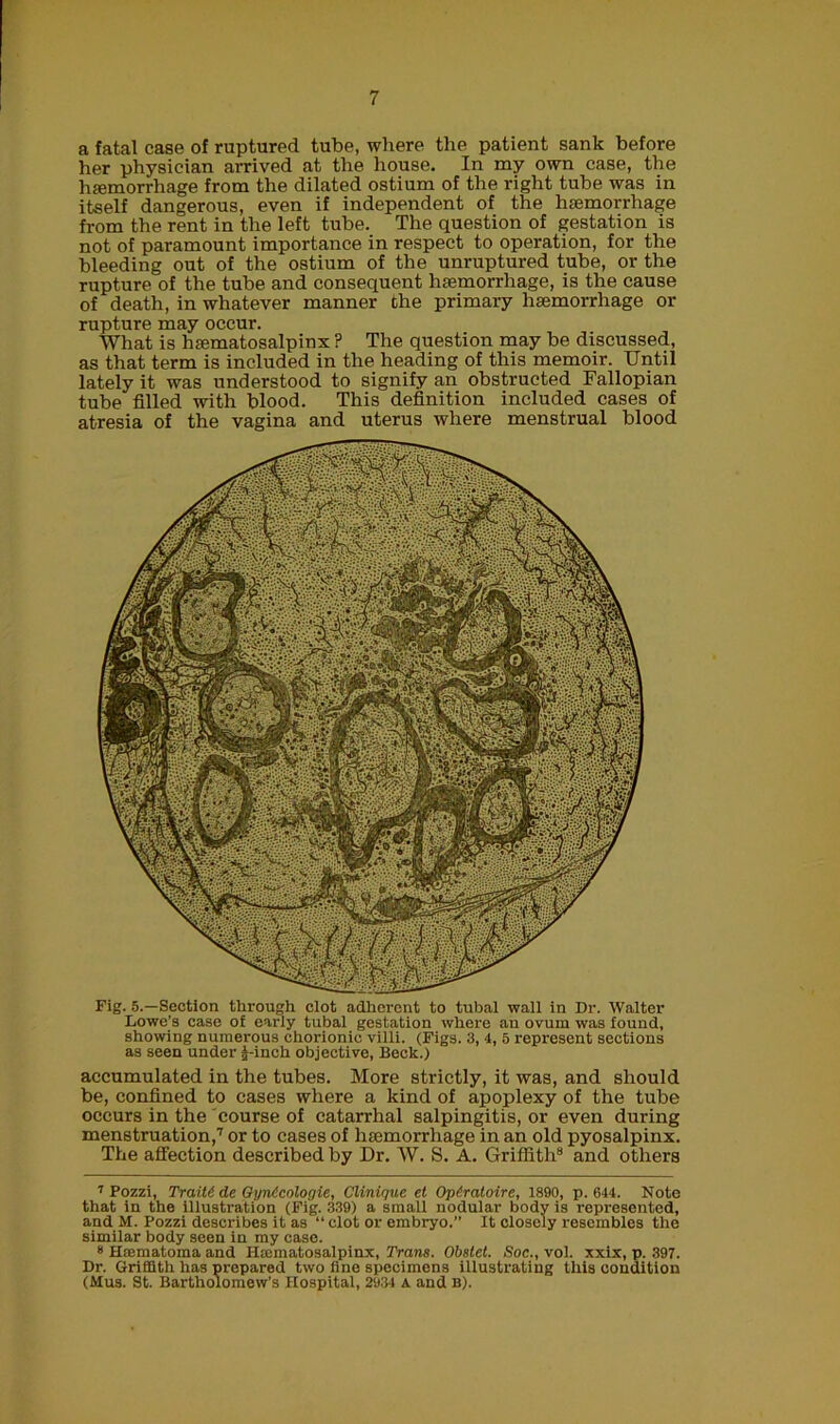 7 Pozzi, Trait6 de Gyntcologie, Clinique et Opiratoire, 1890, p. 644. Note that in the illustration (Fig. 339) a small nodular body is represented, and M. Pozzi describes it as “ clot or embryo.” It closely resembles the similar body seen in my case. 8 Hsematoma and Hsematosalpinx, Trans. Obstet. Soc., vol. xxix, p. 397. Dr. Griffith has prepared two fine specimens illustrating this condition (Mus. St. Bartholomew’s Hospital, 2934 a and b). a fatal case of ruptured tube, where the patient sank before her physician arrived at the house. In my own case, the hemorrhage from the dilated ostium of the right tube was in itself dangerous, even if independent of the haemorrhage from the rent in the left tube._ The question of gestation is not of paramount importance in respect to operation, for the bleeding out of the ostium of the unruptured tube, or the rupture of the tube and consequent haemorrhage, is the cause of death, in whatever manner the primary haemorrhage or rupture may occur. What is hematosalpinx ? The question may be discussed, as that term is included in the heading of this memoir. Until lately it was understood to signify an obstructed Fallopian tube filled with blood. This definition included cases of atresia of the vagina and uterus where menstrual blood Fig. 5.—Section through clot adherent to tubal wall in Dr. Walter Lowe’s case of early tubal gestation where an ovum was found, showing numerous chorionic villi. (Figs. 3, 4, 5 represent sections as seen under |-inch objective, Beck.) accumulated in the tubes. More strictly, it was, and should be, confined to cases where a kind of apoplexy of the tube occurs in the course of catarrhal salpingitis, or even during menstruation,7 or to cases of hemorrhage in an old pyosalpinx. The affection described by Dr. W. S. A. Griffith8 and others