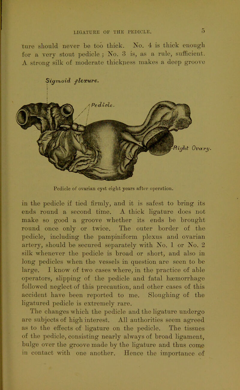 tiire should never be too thick. No. 4 is thick enough for a very stout pedicle ; No. 3 is, as a rule, sufficient. A strong silk of moderate thickjiess makes a deep groove Siffntoid flexure. Pedicle of ovarifin cyst eight years after operation. in the pedicle if tied firmly, and it is safest to bring its ends round a second time. A thick ligature does not make so good a groove whether its ends be brought round once only or twice. The outer border of the pedicle, including the pampiniform plexus and ovarian artery, should be secured separately with No. 1 or No. 2 silk whenever the pedicle is broad or short, and also in long pedicles when the vessels in question are seen to be large. I know of two cases where, in the practice of able operators, slipping of the pedicle and fatal hgemorrhage followed neglect of this precaution, and other cases of this accident have been reported to me. Sloughing of the ligatured pedicle is extremely rare. The changes which the pedicle and the ligature undergo are subjects of high interest. All authorities seem agreed as to the effects of ligature on the pedicle. The tissues of the pedicle, consisting nearly always of broad ligament, bulge over the groove made by the ligature and thus come in contact with one another. Hence the importance of