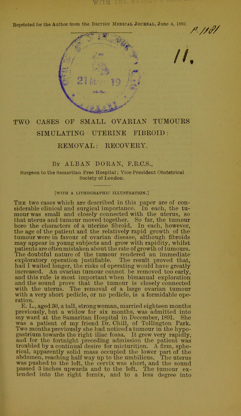 WITH ini a Reprinted for the Author from the British Medical Journal. June 4. 1892. TWO CASES OF SMALL OVARIAN TUMOURS SIMULATING UTERINE FIBROID: By ALBAN DORAN, F.R.C.S., Surgeon to the Samaritan Free Hospital; Vice-President Obstetrical Society of London. The two eases which are described in this paper are of con- siderable clinical and surgical importance. In each, the tu- mour was small and closely connected with the uterus, so that uterus and tumour moved together. So far, the tumour bore the characters of a uterine fibroid. In each, however, the age of the patient and the relatively rapid growth of the tumour were in favour of ovarian disease, although fibroids may appear in young subjects and grow with rapidity, whilst patients are oftenmistaken about the rate of growth of tumours. The doubtful nature of the tumour rendered an immediate exploratory operation justifiable. The result proved that, had I waited longer, the risks of operating would have greatly increased. An ovarian tumour cannot be removed too early, and this rule is most important when bimanual exploration and the sound prove that the tumour is closely connected with the uterus. The removal of a large ovarian tumour with a very short pedicle, or no pedicle, is a formidable ope- ration. E. L., aged 30, a tall, strongwoman, married eighteen months previously, but a widow for six months, was admitted into my ward at the Samaritan Hospital in December, 1891. She was a patient of my friend Dr. Chill, of Tollington Park. Two months previously she had noticed a tumour in the liypo- gastrium towards the right iliac fossa. It grew very rapidly, and for the fortnight preceding admission the patient was troubled by a continual desire for micturition. A firm, sphe- rical, apparently solid mass occupied the lower part of the abdomen, reaching half way up to the umbilicus. The uterus was pushed to the left, the cervix was short, and the sound passed 3 inches upwards and to the left. The tumour ex- tended into the right fornix, and to a less degree into REMOVAL: RECOVERY. [WITH A LITHOGRAPHIC ILLUSTRATION.]