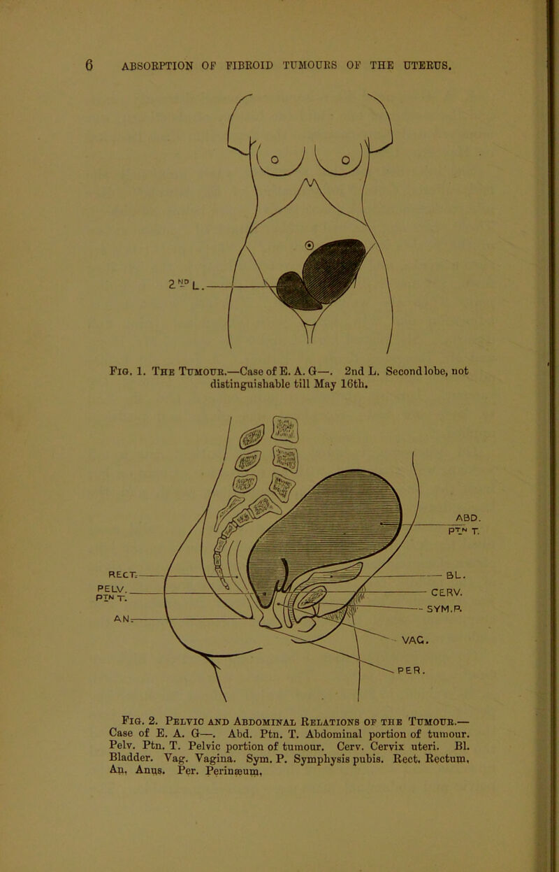Fig. 1. The Tumour.—Case of E. A. G—. 2nd L. Second lobe, not distinguishable till May 16th. Fig. 2. Pelvic and Abdominal Relations of the Tumour.— Case of E. A. G—. Abd. Ptn. T. Abdominal portion of tumour. Pelv. Ptn. T. Pelvic portion of tumour. Cerv. Cervix uteri. Bl. Bladder. Vag. Vagina. Sym. P. Symphysis pubis. Rect. Rectum. An, Anus. Per. Perinaeum,