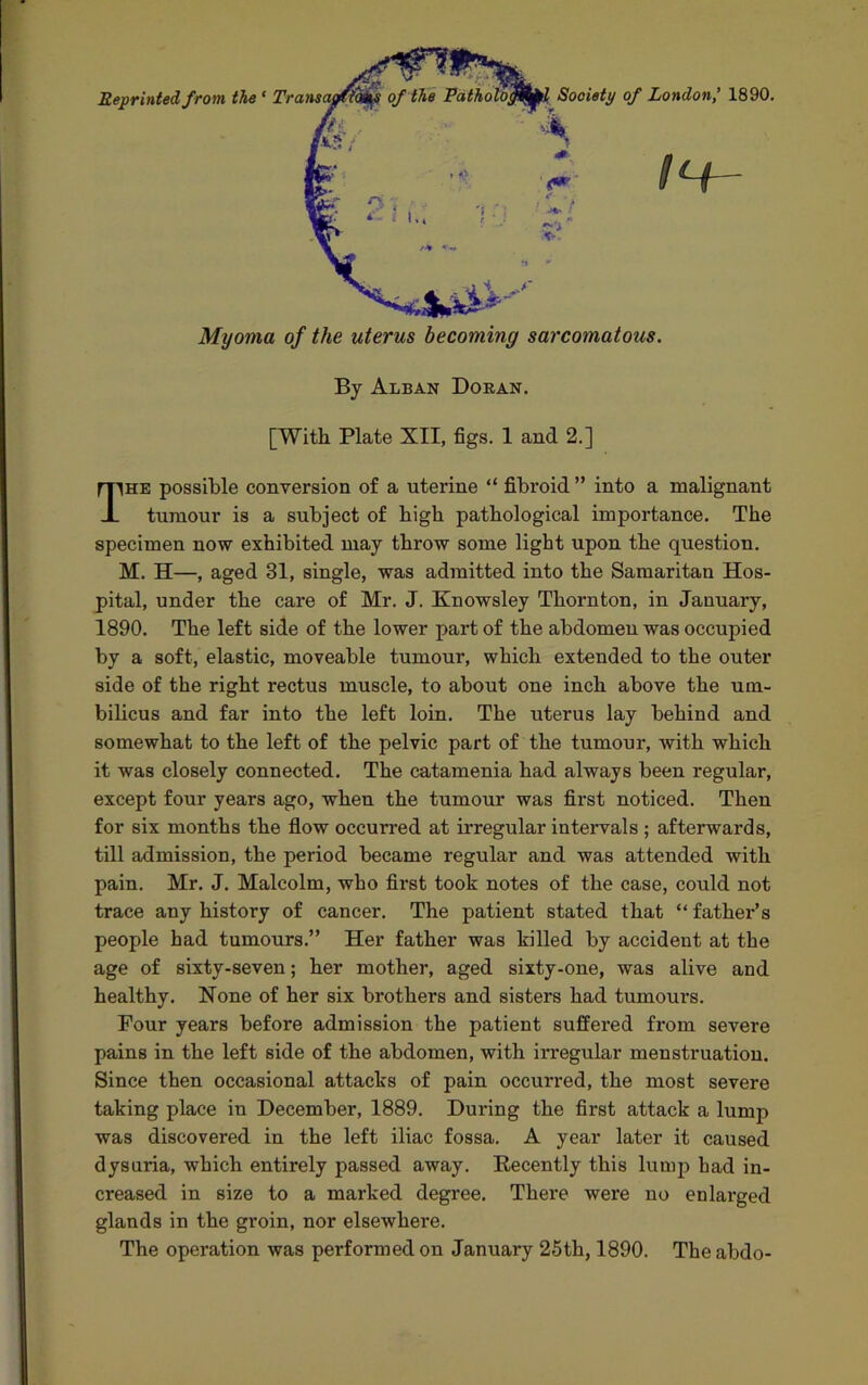 By Alban Doran. [With Plate XII, figs. 1 and 2.] The possible conversion of a uterine “ fibroid ” into a malignant tumour is a subject of high pathological importance. The specimen now exhibited may throw some light upon the question. M. H—, aged 31, single, was admitted into the Samaritan Hos- pital, under the care of Mr. J. Knowsley Thornton, in January, 1890. The left side of the lower part of the abdomen was occupied by a soft, elastic, moveable tumour, which extended to the outer side of the right rectus muscle, to about one inch above the um- bilicus and far into the left loin. The uterus lay behind and somewhat to the left of the pelvic part of the tumour, with which it was closely connected. The catamenia had always been regular, except four years ago, when the tumour was first noticed. Then for six months the flow occurred at irregular intervals ; afterwards, till admission, the period became regular and was attended with pain. Mr. J. Malcolm, who first took notes of the case, could not trace any history of cancer. The patient stated that “father’s people had tumours.” Her father was killed by accident at the age of sixty-seven; her mother, aged sixty-one, was alive and healthy. None of her six brothers and sisters had tumours. Pour years before admission the patient suffered from severe pains in the left side of the abdomen, with irregular menstruation. Since then occasional attacks of pain occurred, the most severe taking place in December, 1889. During the first attack a lump was discovered in the left iliac fossa. A year later it caused dysuria, which entirely passed away. Recently this lump bad in- creased in size to a marked degree. There were no enlarged glands in the groin, nor elsewhere. The operation was performed on January 25th, 1890. Theabdo-