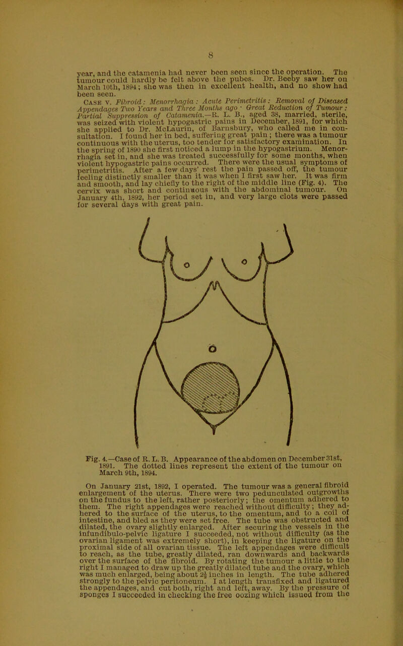 year, and the catamenia had never been seen since the operation. Tho tumour could hardly be felt above the pubes. Dr. Becby saw her on March loth, 1894; she was then in excellent health, and no show had been seen. Case v. Fibroid: Menorrhagia: Acute Perimetritis: Removal of Diseased Appendages Two Years and Three Months ago • Great Reduction of Tumour: Partial 'Suppression of Catamenia.—R. L. B., aged 38, married, sterile, was seized with violent hypogastric pains in December, 1891, for which she applied to Dr. MeLaurin, of Barnsbury, who called me in con- sultation. I found her in bed, suffering great pain ; there was a tumour continuous with the uterus, too tender for satisfactory examination. In the spring of 1890 she first noticed a lump in the hypogastrium. Menor- rhagia set in, and she was treated successfully for some months, when violent hypogastric pains occurred. There were the usual symptoms of perimetritis. After a few days’ rest the pain passed off, the tumour feeling distinctly smaller than it was when I first saw her. It was firm and smooth, and lay chiefly to the right of tho middle line (Fig. 4). The cervix was short and continuous with the abdominal tumour. On January 4tli, 1892, her period set in, and very large clots were passed for several days with great pain. Fig. 4. —Case of R. L. B. Appearance of the abdomen on December 31st, 1891. The dotted lines represent the extent of the tumour on March 9th, 1894. On January 21st, 1892, I operated. The tumour was a general fibroid enlargement of the uterus. There were two pedunculated outgrowths on the fundus to the left, rather posteriorly; the omentum adhered to them. The right appendages were reached without difficulty; they ad- hered to the surface of the uterus, to the omentum, and to a coil of intestine, and bled as they were set free. The tube was obstructed and dilated, the ovary slightly enlarged. After securing the vessels in the infundibulo-pelvic ligature I succeeded, not without difficulty (as the ovarian ligament was extremely short), in keeping the ligature on the proximal side of all ovarian tissue. The left appendages were difficult to reach, as the tube, greatly dilated, ran downwards and backwards over the surface of the fibroid. By rotating the tumour a little to the right I managed to draw up the greatly dilated tube and the ovary, which was much enlarged, being about 2$ inches in length. The tube adhered strongly to the pelvic peritoneum. I at length transfixed and ligatured the appendages, and cut both, right and left, away. By the pressure of sponges I succeeded in checking the free oozing which issued from the