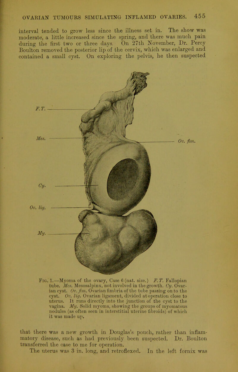 interval tended to grow less since the illness set in. The show was moderate, a little increased since the spring, and there was much pain during the first two or three days. On 27th November, Dr. Percy Boulton removed the posterior lip of the cervix, which was enlarged and contained a small cyst. On exploring the pelvis, he then suspected Fig. 1.—Myonici of the ovary, Case 6 (nat. size.) F.T. Fallopian tube. Mes. Mesosalpinx, not involved in the growth. Cy. Ovar- ian cyst. Ov.fim. Ovarian fimbria of the tube passing on to the cyst. Ov. lig. Ovarian ligament, divided at operation close to uterus. It runs directly into the junction of the cyst to the vagina. My. Solid myoma, showing the groups of myomatous nodules (as often seen in interstitial uterine fibroids) of which it was made up. that there was a new growth in Douglas’s pouch, rather than inflam- matory disease, such as had previously been suspected. Dr. Boulton transferred the case to me for operation. The uterus was 3 in. long, and retroflexed. In the left fornix was