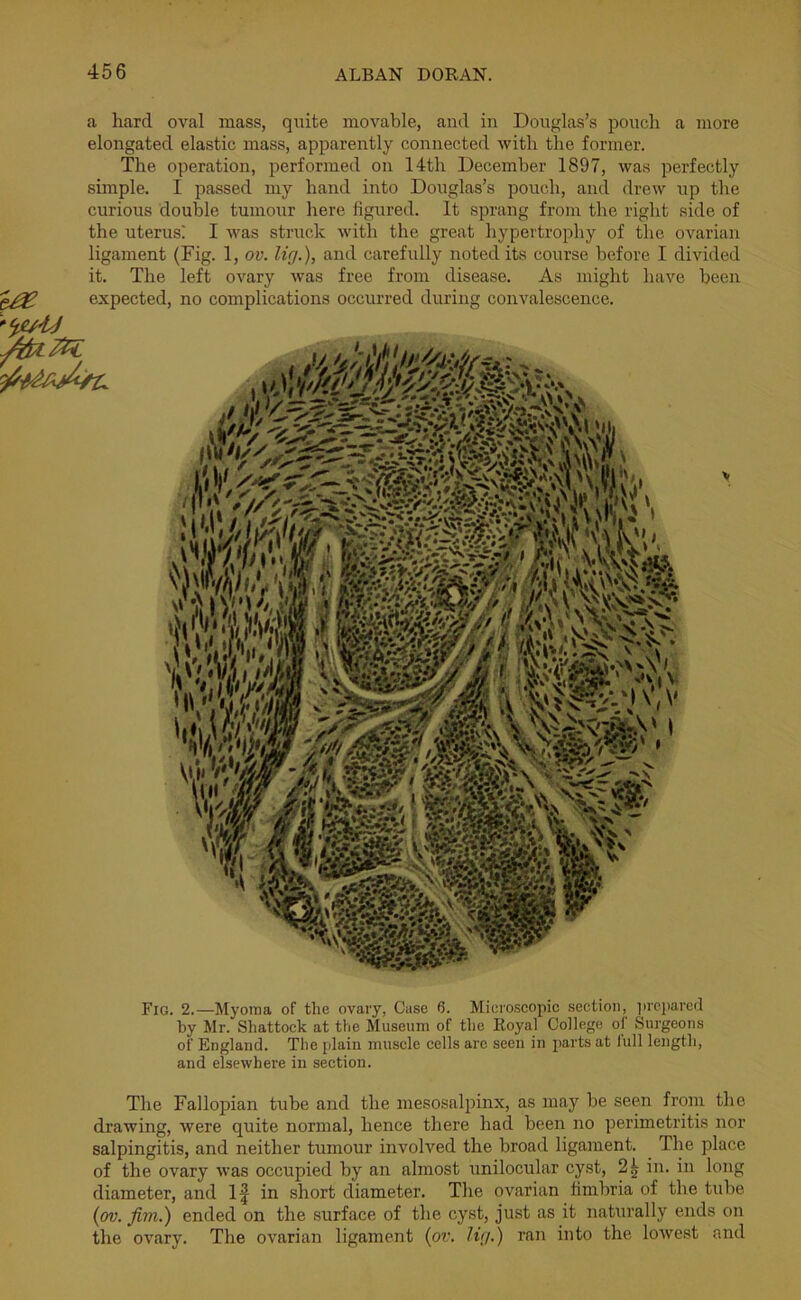 a hard oval mass, quite movable, and in Douglas’s pouch a more elongated elastic mass, apparently connected with the former. The operation, performed on 14tli December 1897, was perfectly simple. I passed my hand into Douglas’s pouch, and drew up the curious double tumour here figured. It sprang from the right side of the uterusi I was struck with the great hypertrophy of the ovarian ligament (Fig. 1, ov. lig.), and carefully noted its course before I divided it. The left ovary was free from disease. As might have been expected, no complications occurred during convalescence. Fig. 2.—Myoma of the ovary, Case 6. Microscopic section, prepared by Mr. Shattock at the Museum of the Royal College of Surgeons of England. The plain muscle cells arc seen in parts at lull length, and elsewhere in section. The Fallopian tube and the mesosalpinx, as may be seen from the drawing, were quite normal, hence there had been no perimetritis nor salpingitis, and neither tumour involved the broad ligament. The place of the ovary was occupied by an almost unilocular cyst, 2^ in. in long diameter, and If in short diameter. The ovarian fimbria of the tube (ov. Jim.) ended on the surface of the cyst, just as it naturally ends on the ovary. The ovarian ligament (ov. lig.) ran into the lowest and