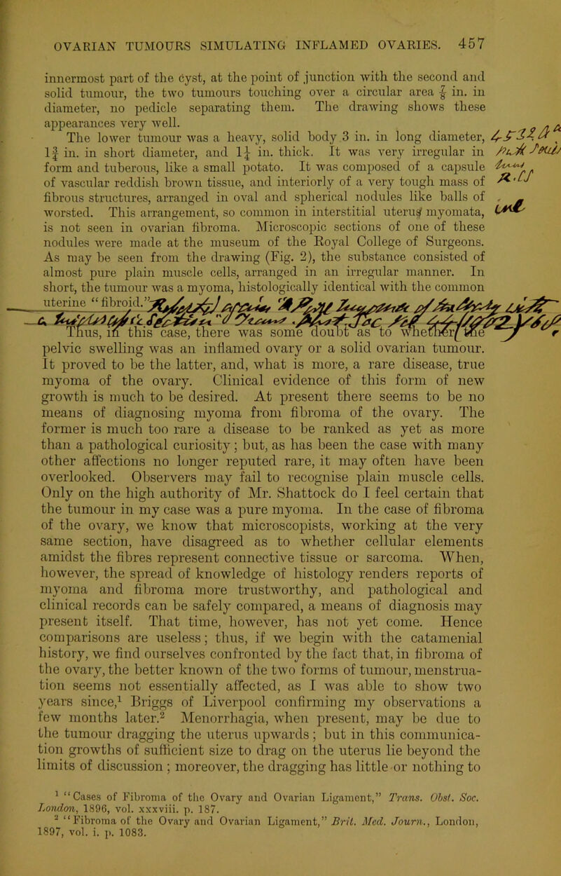 innermost part of the cyst, at the point of junction with the second and solid tumour, the two tumours touching over a circular area f- in. in diameter, no pedicle separating them. The drawing shows these appearances very well. o a A The lower tumour was a heavy, solid body 3 in. in long diameter, ft s If in. in short diameter, and If in. thick. It was very irregular in frtjfcSmUj form and tuberous, like a small potato. It was composed of a capsule of vascular reddish brown tissue, and interiorly of a very tough mass of fibrous structures, arranged in oval and spherical nodules like balls of worsted. This arrangement, so common in interstitial uteru^f myomata, is not seen in ovarian fibroma. Microscopic sections of one of these nodules were made at the museum of the Royal College of Surgeons. As may he seen from the drawing (Fig. 2), the substance consisted of almost pure plain muscle cells, arranged in an irregular manner. In short, the tumour was a myoma, histologically identical with the common uterine “ fibroid.>4-J /i/wA. cafrtAv fr.CJ Thus, in this case, there was some doubt as to whether/ toe r - pelvic swelling was an inflamed ovary or a solid ovarian tumour. It proved to be the latter, and, what is more, a rare disease, true myoma of the ovary. Clinical evidence of this form of new growth is much to be desired. At present there seems to be no means of diagnosing myoma from fibroma of the ovary. The former is much too rare a disease to be ranked as yet as more than a pathological curiosity; but, as has been the case with many other affections no longer reputed rare, it may often have been overlooked. Observers may fail to recognise plain muscle cells. Only on the high authority of Mr. Shattock do I feel certain that the tumour in my case was a pure myoma. In the case of fibroma of the ovary, we know that microscopists, working at the very same section, have disagreed as to whether cellular elements amidst the fibres represent connective tissue or sarcoma. When, however, the spread of knowledge of histology renders reports of myoma and fibroma more trustworthy, and pathological and clinical records can be safely compared, a means of diagnosis may present itself. That time, however, has not yet come. Hence comparisons are useless; thus, if we begin with the catamenial history, we find ourselves confronted by the fact that, in fibroma of tbe ovary, the better known of the two forms of tumour, menstrua- tion seems not essentially affected, as I was able to show two years since,1 Briggs of Liverpool confirming my observations a few months later.2 Menorrhagia, when present, may be due to the tumour dragging the uterus upwards; but in this communica- tion growths of sufficient size to drag on the uterus lie beyond the limits of discussion ; moreover, the dragging has little or nothing to 1 “Cases of Fibroma of the Ovary and Ovarian Ligament,” Trans. Obst. Soc. London, 1896, vol. xxxviii. p. 187. 2 “Fibroma of the Ovary and Ovarian Ligament,” Brit. Med. Journ., London, 1897, vol. i. p. 1083.