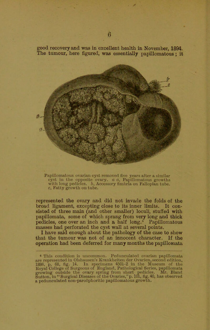 . ^ 6 good recovery and was in excellent health in November, 1894. The tumour, here figured, was essentially papillomatous; it Papillomatous ovarian cyst removed live years after a similar e.yst in the opposite ovary, a a, Papillomatous growths with long pedicles, b, Accessory fimbria on Fallopian tube, c. Fatty growth on tube. represented the ovary and did not invade the folds of the broad ligament, excepting close to its inner limits. It con- sisted of three main (and other smaller) loculi, stuffed with papillomata, some of which sprang from very long and thick pedicles, one over an inch and a half long.1 Papillomatous masses had perforated the cyst wall at several points. I have said enough about the pathology of the case to show that the tumour was not of an innocent character. If the operation had been deferred for many months the papillomata * This condition is uncommon. Pedunculated ovarian papillomata are represented in Olsbausen’s Krankheiten der Ovarien, second edition, 1886, p. 68, fig. 14. In specimens 4501-2 in the Museum of the ltoyal College of Surgeons of England, Pathological Series, papillomata growing outside the ovary spring from short pedicles. Mr. Bland Sutton, in “ Surgical Diseases of the Ovaries, p. 101, fig. 40, has observed a pedunculated non-paroophoritic papillomatous growth.