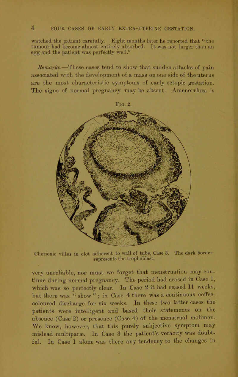 watched the patient cjirefully. Eight months later he reported that “ the tumour had become almost entirely absorbed. It was not larger than an egg and the patient w;vs j)erfectly well.” Remarks.—These cases tend to show that sudden attacks of pain associated with the development of a mass on one side of the uterus are the mo.st characteristic symptoms of early ectopic gestation. The signs of normal pregnancy may be absent. Amenorrhoea is Fig. 2. Chorionic villuB in clot adherent to wall of tube, Case 3. The dark border represents the trophoblast. very uui’eliable, nor must we forget that menstruation may con- tinue during nonnal pregnancy. The period had ceased in Case 1, which was so perfectly clear. In Case 2 it had ceased 11 weeks, but there was “ show ” ; in Case 4 there was a continuous coffee- coloured discharge for six weeks. In these two latter cases the patients were intelligent and based their statements on the absence (Case 2) or presence (Case 4) of the menstrual molimeii. We know, however, that this purely subjective symptom may mislead multipara). In Case 3 the patient’s veracity was doubt- ful. In Case 1 alone was there any tendency to the changes in