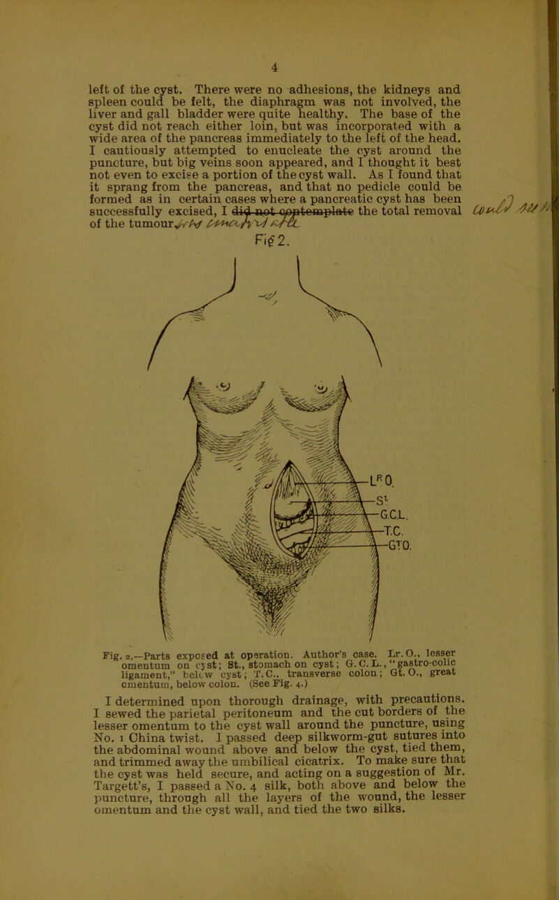 left of the cyst. There were no adhesions, the kidneys and spleen could be felt, the diaphragm was not involved, the liver and gall bladder were quite healthy. The base of the cyst did not reach either loin, but was incorporated with a wide area of the pancreas immediately to the left of the head. I cautiously attempted to enucleate the cyst around the puncture, but big veins soon appeared, and I thought it best not even to excise a portion of the cyst wall. As I found that it sprang from the pancreas, and that no pedicle could be formed as in certain cases where a pancreatic cyst has been successfully excised, I not c^tomplate the total removal 2. of the tumour^vA/ I determined upon thorough drainage, with precautions. I sewed the parietal peritoneum and the cut borders of the lesser omentum to the cyst wall around the puncture, using No. i China twist. I passed deep silkworm-gut sutures into the abdominal wound above and below the cyst, tied them, and trimmed away the umbilical cicatrix. To make sure that the cyst was held secure, and acting on a suggestion of Mr. Targett’s, I passed a No. 4 silk, both above and below the puncture, through all the layers of the wound, the lesser omentum and the cyst wall, and tied the two silks. Q)id^