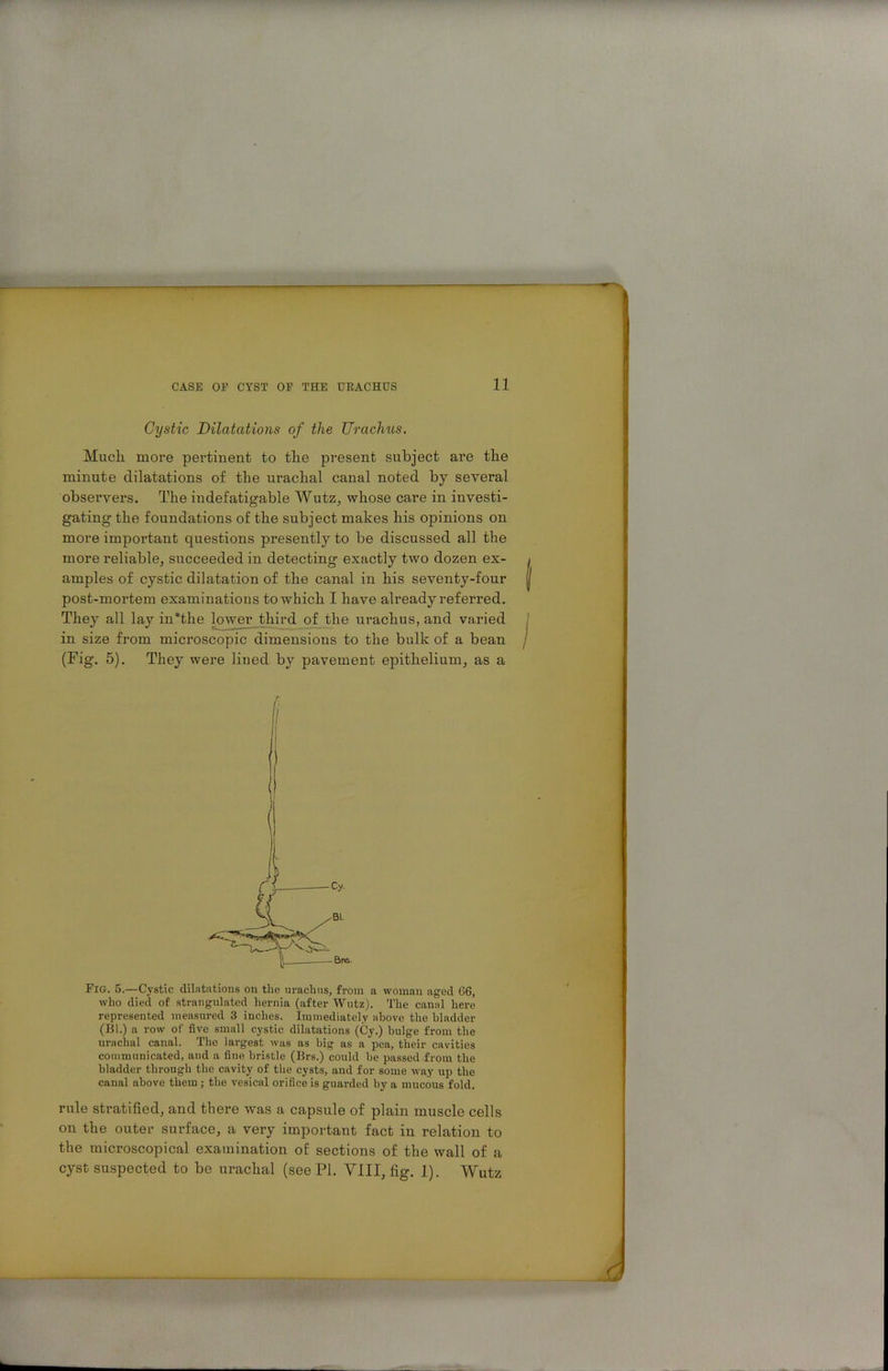 Cystic Dilatations of the Urachus. Much more pertinent to the present subject are the minute dilatations of the urachal canal noted by several observers. The indefatigable Wutz, whose care in investi- gating the foundations of the subject makes his opinions on more important questions presently to be discussed all the more reliable, succeeded in detecting exactly two dozen ex- amples of cystic dilatation of the canal in his seventy-four post-mortem examinations to which I have already referred. They all lay in'the lower third of the urachus, and varied in size from microscopic dimensions to the bulk of a bean (Fig. 5). They were lined by pavement epithelium, as a Fig. 5—Cystic dilatations on the urachus, from a woman aged 66, who died of strangulated hernia (after Wutz). The canal here represented measured 3 inches. Immediately above the bladder (Bl.) a row of five small cystic dilatations (Cy.) bulge from the urachal canal. The largest was as big as a pea, their cavities communicated, and a fine bristle (Brs.) could be passed from the bladder through the cavity of the cysts, and for some way up the canal above them; the vesical orifice is guarded by a mucous fold. rule stratified, and there was a capsule of plain muscle cells on the outer surface, a very important fact in relation to the microscopical examination of sections of the wall of a cyst suspected to be urachal (see PI. VIII, fig. 1). Wutz