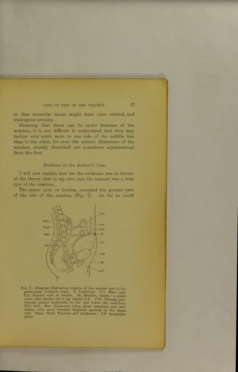 so that muscular tissue might have once existed, and undergone atrophy. Granting that there can be cystic tumours of the urachus, it is not difficult to understand that they may incline very much more to one side of the middle line than to the other, for even the minute dilatations of the urachus already described are sometimes asymmetrical from the first. Evidence in the Author’s Case. I will now explain how far the evidence was in favour of the theory that in my own case the tumour was a true cyst of the urachus. The upper cyst, or loculus, occupied the greater part of the site of the urachus (Fig. 7). As far as could Fig. 7.—Diagram illustrating relation of the urachal cyst to the peritoneum (author’s case). U. Umbilicus. C.l. Main cyst. C.2. Smaller cyst or loculus. Bl. Bladder, empty; a sound could raise fundus till it lay behind C.2. P.P. Parietal peri- toneum pushed backwards by the cyst below the umbilicus. T.C., G.O., Mes. Transverse colon, great omentum, and mes- entery, with small intestine displaced upwards by the larger cyst. Pane., Duod. Pancreas and duodenum. S.P. Symphysis pubis.