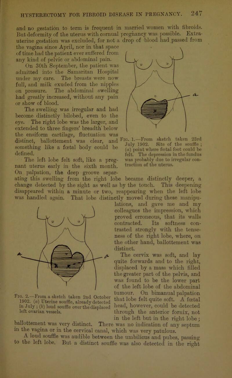 <a- Fig. 1.—From sketch taken 23nl July 1902. Site of the souffle ; (a) point where fcetal foot could be felt. The depression in the fundus was probably due to irregular con- traction of the uterus. and no gestation to term is frequent in married women with fibroids. But deformity of the uterus witli cornual pregnancy was possible. Extra- uterine gestation was excluded, for not a drop of blood had passed from the vagina since April, nor in that space of time had the patient ever suffered from any kind of pelvic or abdominal pain. On 30th September, the patient was admitted into the Samaritan Hospital under my care. The breasts were now full, and milk exuded from the nipples on pressure. The abdominal swelling had greatly increased, without any pain or show of blood. The swelling was irregular and had become distinctly bilobed, even to the eye. The right lobe was the larger, and extended to three fingers’ breadth below the ensiform cartilage, fluctuation was distinct, ballottement was clear, and something like a fcetal body could be defined. The left lobe felt soft, like a preg- nant uterus early in the sixth month. On palpation, the deep groove separ- ating this swelling from the right lobe became distinctly deeper, a change detected by the sight as well as by the touch. This deepening disappeared within a minute or two, reappearing when the left lobe was handled again. That lobe distinctly moved during these manipu- lations, and gave me and my colleagues the impression, which proved erroneous, that its walls contracted. Its softness con- trasted strongly with the tense- ness of the right lobe, where, on the other hand, ballottement was distinct. The cervix was soft, and lay quite forwards and to the right, displaced by a mass which filled the greater part of the pelvis, and was found to be the lower part of the left lobe of the abdominal tumour. On bimanual palpation that lobe felt quite soft. A foetal head, however, could be detected through the anterior fornix, not in the left but in the right lobe ; ballottement was very distinct. There was no indication of any septum in the vagina or in the cervical canal, which was very patulous. A loud souffle was audible between the umbilicus and pubes, passing to the left lohe. But a distinct souffle was also detected in the right Fig. 2.—From a sketcli taken 2nd October 1902. (a) Uterine souffle, already detected in July ; (i) loud souffle over the displaced left ovarian vessels.