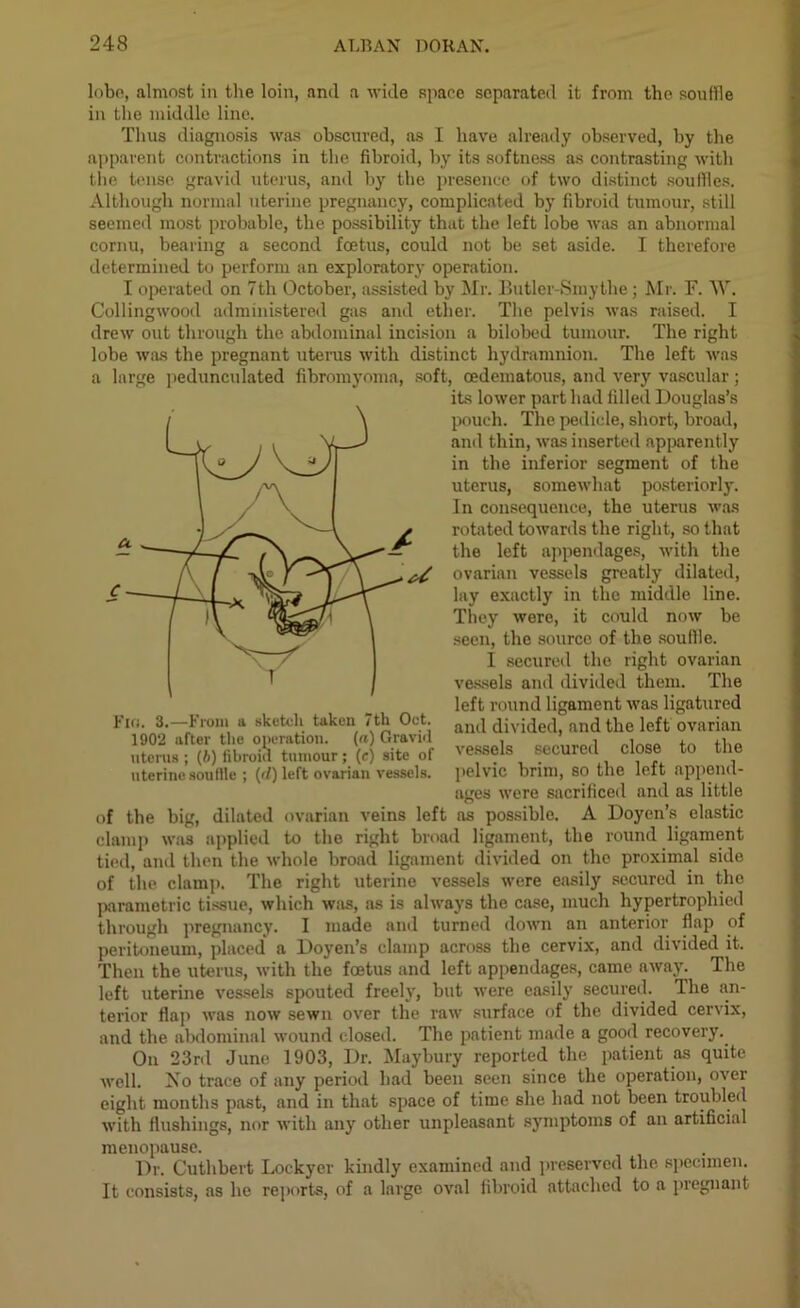 lobe, almost in the loin, anil a wide space separated it from the souffle in the middle line. Thus diagnosis was obscured, as I have already observed, by the apparent contractions in the fibroid, by its softness as contrasting with the tense gravid uterus, and by the presence of two distinct souffles. Although normal uterine pregnancy, complicated by fibroid tumour, still seemed most probable, the possibility that the left lobe was an abnormal cornu, bearing a second foetus, could not be set aside. I therefore determined to perform an exploratory operation. I operated on 7th October, assisted by Mr. Butler-Smythe; Mr. F. TV. Collingwood administered gas and ether. The pelvis was raised. I drew out through the abdominal incision a bilobeil tumour. The right lobe was the pregnant uterus with distinct hydramnion. The left was a large pedunculated fibromyoma, soft, oedematous, and very vascular; its lower part had filled Douglas’s pouch. The pedicle, short, broad, and thin, was inserted apparently in the inferior segment of the uterus, somewhat posteriorly. In consequence, the uterus was rotated towards the right, so that the left appendages, with the ovarian vessels greatly dilated, lay exactly in the middle line. They were, it could now be seen, the source of the souffle. I secured the right ovarian vessels and divided them. The left round ligament was ligatured and divided, and the left ovarian vessels secured close to the pelvic brim, so the left append- ages were sacrificed and as little of the big, dilated ovarian veins left as possible. A Doyen’s elastic clamp was applied to the right broad ligament, the round ligament tied, and then the whole broad ligament divided on the proximal side of the clamp. The right uterine vessels were easily secured in the parametric tissue, which was, as is always the case, much hypertrophied through pregnancy. I made and turned down an anterior flap of peritoneum, placed' a Doyen’s clamp across the cervix, and divided it. Then the uterus, with the foetus and left appendages, came away left uterine vessels spouted freely, but were easily secured, terior flap was now sewn over the raw surface of the divided cervix, and the abdominal wound closed. The patient made a good recovery. On 23rd June 1903, Dr. Maybury reported the patient as quite well. No trace of any period had been seen since the operation, over eight months past, and in that space of time she had not been troubled with flushings, nor with any other unpleasant symptoms of an artificial menopause. Dr. Cuthbert Lockyer kindly examined and preserved the specimen. It consists, as he reports, of a large oval fibroid attached to a piegnant Fin. 3.—From a sketch taken 7tlx Oct. 1902 after the operation, (a) Gravid uterus ; (6) fibroid tumour; (e) site of uterine souffle ; (d) left ovarian vessels. of it. The The an-