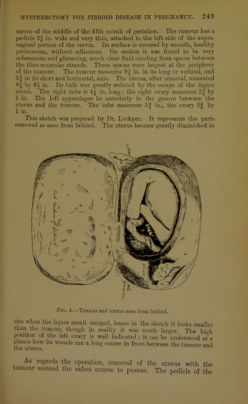 uterus of the middle of the fifth month of gestation. The tumour lias a pedicle 2-f in. wide and very thin, attached to the left side of the supra- vaginal portion of the cervix. Its surface is covered by smooth, healthy peritoneum, without adhesions. On section it was found to be very oedematous and glistening, much clear fluid exuding from spaces between the fibro-muscular strands. These spaces were largest at the periphery of the tumour. The tumour measures 9{ in. in its long or vertical, and 5'I in its short and horizontal, axis. The uterus, after removal, measured 8| by 64 in. Its bulk was greatly reduced by the escape of the liquor arnnii. The right tube is 4| in. long; the right ovary measures 2f by 1 in. The left appendages lie anteriorly in the groove between the uterus and the tumour. The tube measures 5f in., the ovary 2f by 1 in. This sketch was prepared by Dr. Lockyer. It represents the parts removed as seen from behind. The uterus became greatly diminished in Fig. 4.—Tumour and uterus seen from behind. sue when the liquor arnnii escaped, hence in the sketch it looks smaller than the tumour, though in reality it was much larger. The hmh position of the left ovary is well indicated; it can be understood at a glance how its vessels ran a long course in front between the tumour and the uterus. As regards the operation, removal of the uterus with the tumour seemed the safest course to pursue. The pedicle of the