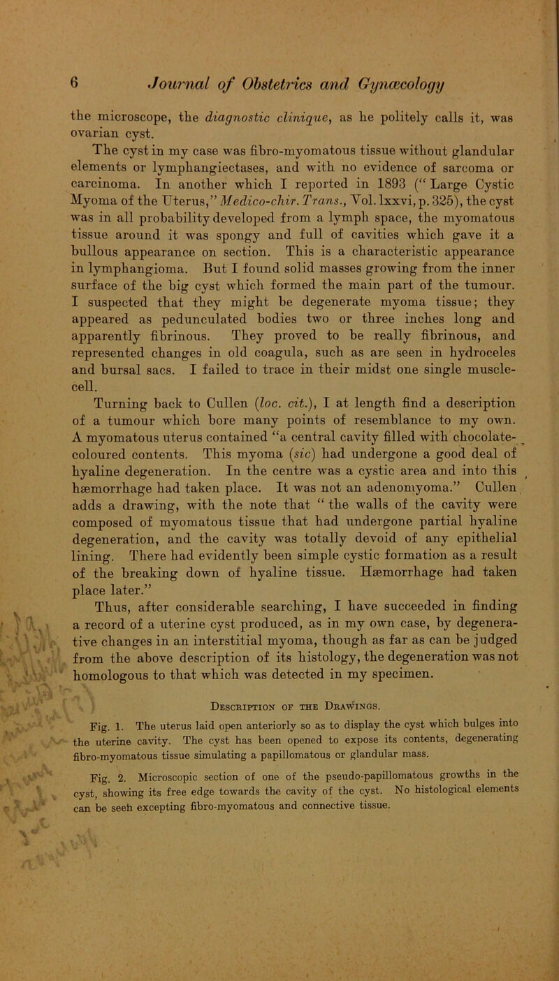 the microscope, the diagnostic clinique, as he politely calls it, was ovarian cyst. The cyst in my case was fihro-myomatous tissue without glandular elements or lymphangiectases, and with no evidence of sarcoma or carcinoma. In another which I reported in 1893 (“ Large Cystic Myoma of the Uterus,” Medico-chir. Trans., Yol. lxxvi, p. 325), the cyst was in all probability developed from a lymph space, the myomatous tissue around it was spongy and full of cavities which gave it a bullous appearance on section. This is a characteristic appearance in lymphangioma. But I found solid masses growing from the inner surface of the big cyst which formed the main part of the tumour. I suspected that they might be degenerate myoma tissue; they appeared as pedunculated bodies two or three inches long and apparently fibrinous. They proved to be really fibrinous, and represented changes in old coagula, such as are seen in hydroceles and bursal sacs. I failed to trace in their midst one single muscle- cell. Turning back to Cullen (loc. cit.), I at length find a description of a tumour which bore many points of resemblance to my own. A myomatous uterus contained “a central cavity filled with chocolate- coloured contents. This myoma (sic) had undergone a good deal of hyaline degeneration. In the centre was a cystic area and into tbis haemorrhage had taken place. It was not an adenomyoma.” Cullen adds a drawing, with the note that “ the walls of the cavity were composed of myomatous tissue that had undergone partial hyaline degeneration, and the cavity was totally devoid of any epithelial lining. There had evidently been simple cystic formation as a result of the breaking down of hyaline tissue. Haemorrhage had taken place later.” Thus, after considerable searching, I have succeeded in finding a record of a uterine cyst produced, as in my own case, by degenera- tive changes in an interstitial myoma, though as far as can be judged from the above description of its histology, the degeneration was not homologous to that which was detected in my specimen. '•’*1 ^ Description of the Dealings. Fig. 1. The uterus laid open anteriorly so as to display the cyst which bulges into the uterine cavity. The cyst has been opened to expose its contents, degenerating fibro-myomatous tissue simulating a papillomatous or glandular mass. Fig. 2. Microscopic section of one of the pseudo-papillomatous growths in the cyst, showing its free edge towards the cavity of the cyst. No histological elements can be seeh excepting fibro-myomatous and connective tissue.