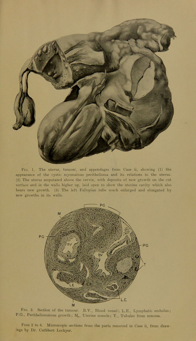 appearance of the cystic myomatous perithelioma and its relations to the uterus. (2) The uterus amputated above the cervix, with deposits of new growth on the cut surface and in the walls higher up, laid open to show the uterine cavity which also bears new growth. (3) The left Fallopian tube much enlarged and elongated by new growths in its walls. l'lo. 2. Section of the tumour. B.V., Blood vessel; L.E., Lymphatic embolus; P.G., Peritheliomatous growth; M», Uterine muscle; T., Tubules from mucosa. h igs 2 to 6. Microscopic sections from the parts removed in Case ii, from draw- ings by Dr. Cuthbert Lockyer.