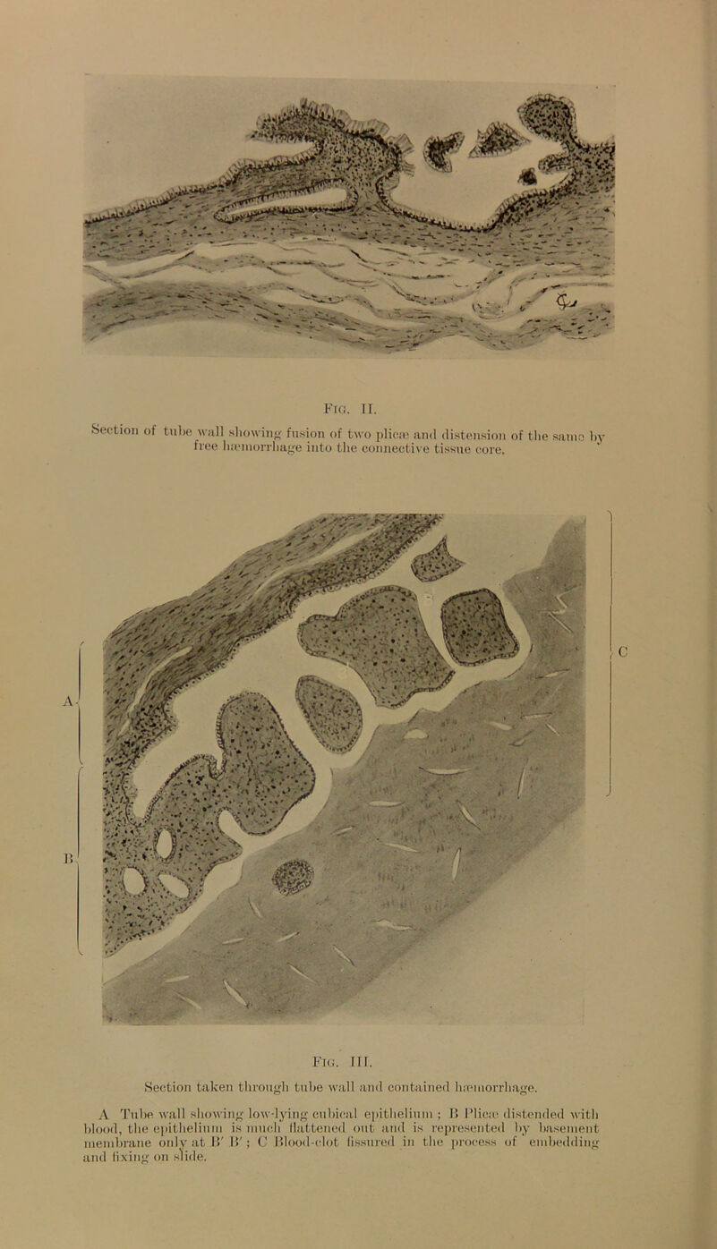 Fig. II. Section of tube wall showing fusion of two plicie and distension of the same by free haemorrhage into the connective tissue core. Fig. III. Section taken through tube wall and contained haemorrhage. A Tube wall showing low-lying cubical epithelium ; II Plica- distended with blood, the epithelium is much llattened out and is represented by basement membrane only at II' IT ; C Blood-clot fissured in the process of embedding and fixing on slide.