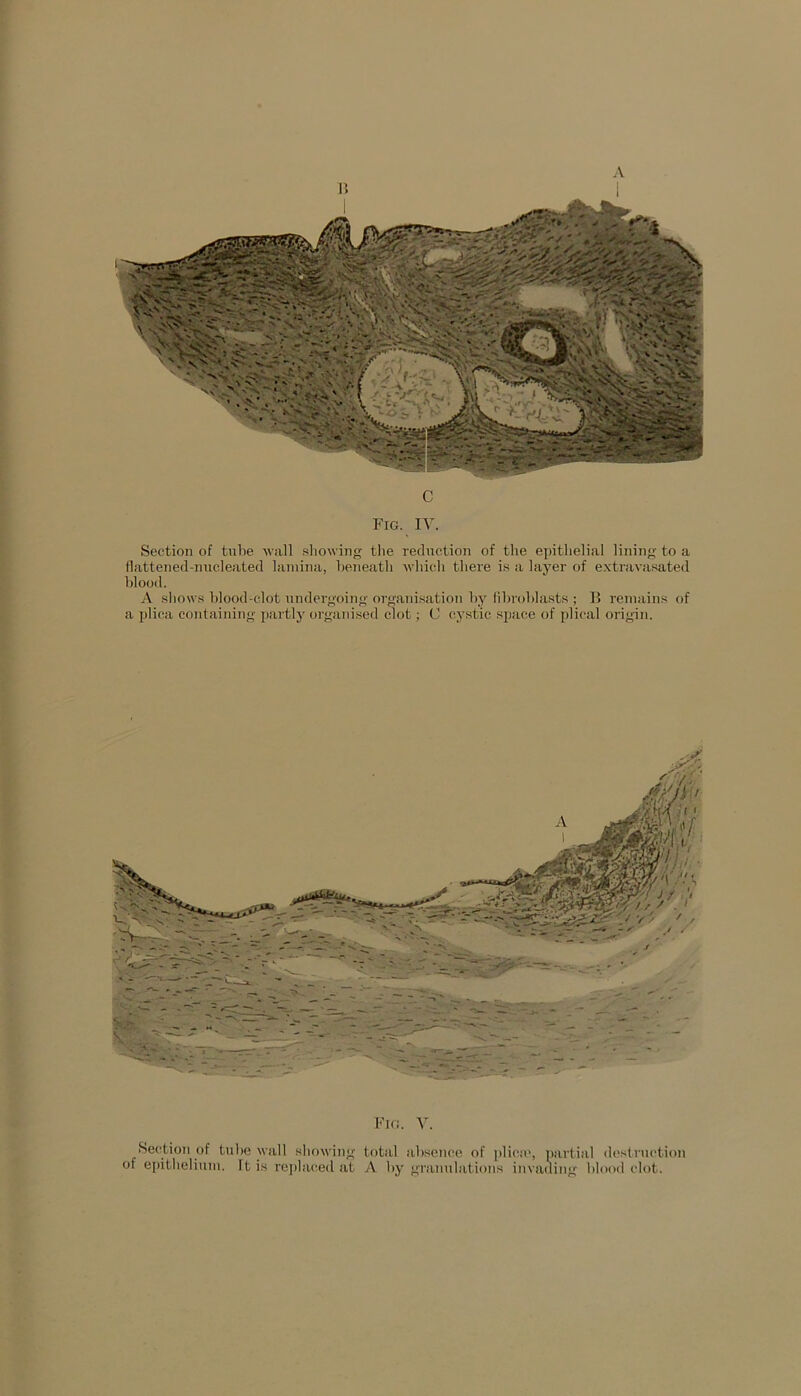 I c Fig. IY. Section of tube wall showing the reduction of the epithelial lining to a flattened-nucleated lamina, beneath which there is a layer of extravasated blood. A shows blood-clot undergoing organisation by fibroblasts ; B remains of a plica containing partly organised clot; C cystic space of plical origin. Fig. Y. Section of tube wall showing total absence of plica', partial destruction of epithelium. It is replaced at A by granulations invading blood clot.