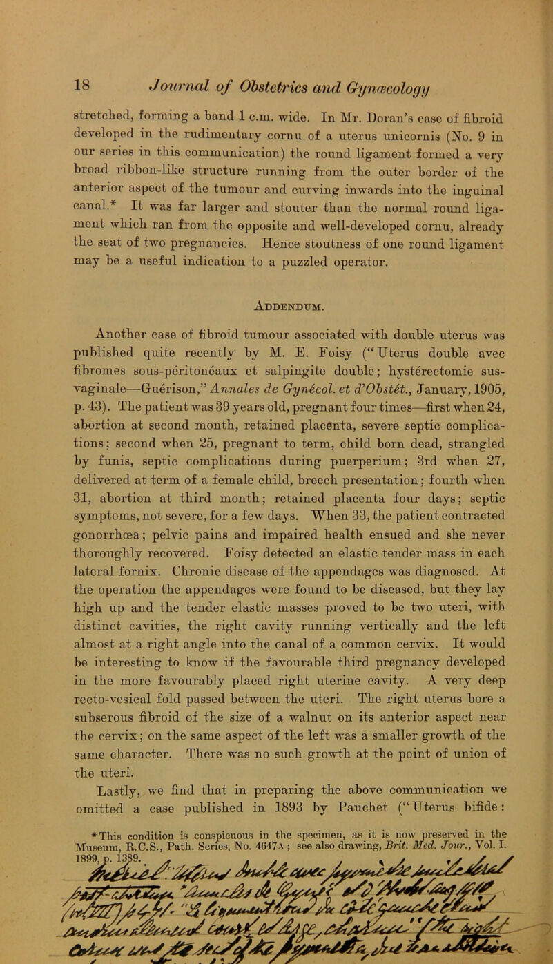 stretched, forming a band 1 c.m. wide. In Mr. Doran’s case of fibroid developed in the rudimentary cornu of a uterus unicornis (No. 9 in our series in this communication) the round ligament formed a very broad ribbon-like structure running from the outer border of the anterior aspect of the tumour and curving inwards into the inguinal canal.* It was far larger and stouter than the normal round liga- ment wliicb ran from the opposite and well-developed cornu, already the seat of two pregnancies. Hence stoutness of one round ligament may be a useful indication to a puzzled operator. Addendum. Another case of fibroid tumour associated with double uterus was published quite recently by M. E. Foisy (“Uterus double avec fibromes sous-peritoneaux et salpingite double; hysterectomie sus- vaginale—Guerison,” Annates de Gynecol, et d’Obstet., January, 1905, p. 43). The patient was 39 years old, pregnant four times—first when 24, abortion at second month, retained placenta, severe septic complica- tions; second when 25, pregnant to term, child born dead, strangled by funis, septic complications during puerperium; 3rd when 27, delivered at term of a female child, breech presentation; fourth when 31, abortion at third month; retained placenta four days; septic symptoms, not severe, for a few days. When 33, the patient contracted gonorrhoea; pelvic pains and impaired health ensued and she never thoroughly recovered. Eoisy detected an elastic tender mass in each lateral fornix. Chronic disease of the appendages was diagnosed. At the operation the appendages were found to be diseased, but they lay high up and the tender elastic masses proved to be two uteri, with distinct cavities, the right cavity running vertically and the left almost at a right angle into the canal of a common cervix. It would be interesting to know if the favourable third pregnancy developed in the more favourably placed right uterine cavity. A very deep recto-vesical fold passed between the uteri. The right uterus bore a subserous fibroid of the size of a walnut on its anterior aspect near the cervix; on the same aspect of the left was a smaller growth of the same character. There was no such growth at the point of union of the uteri. Lastly, we find that in preparing the above communication we omitted a case published in 1893 by Pauchet (“Uterus bifide: *This condition is conspicuous in the specimen, as it is now preserved in the Museum, R.C.S., Path. Series, No. 4647a ; see also drawing, Brit. Med. Jour., Vol. I.