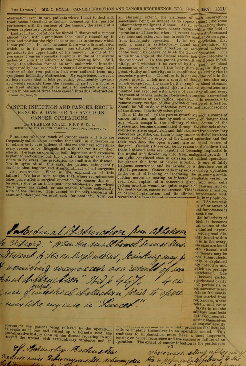 The Lancet,] MR. 0. RYALL : CANCER INFECTION AND CANCER RECURRENCE, ETC. [Nov. 9,1907. 1311/ obstruction even in two patients where I had to deal with troublesome intestinal adhesions connecting the parietal peritoneum with the surface of the tumour, the result of a former exploratory operation. Lastly, in two operations for fibroid I discovered a tumour almost fixed, with a prominent lobe closely resembling in form and position the right lobe or tumour in the case which I now publish. In each instance there was a firm adhesion which, as in the present case, was situated immediately posterior to the upper limits of the tumour. In one of the two cases it was an appendix epiploica, in the other several inches of ileum that adhered to the projecting lobe. Still, though the adhesion formed an arch under which intestine might readily have become incarcerated or even strangulated neither of the two patients had ever suffered from any symptoms indicating obstruction. My experience, however, at least shows that a lobe projecting prominently upwards and widely separate from the remaining part of a more or less fixed uterine fibroid is liable to contract adhesions which in one out of three cases caused intestinal obstruction. Granville-place, W. CANCER INFECTION AND CANCER RECUR- RENCE: A DANGER TO AVOID IN CANCER OPERATIONS. By CHARLES RYALL, F.R O.S. Eng., SURGEON TO THE CANCER HOSPITAL, BROSIPTON, LONDON, W. Subgeons who see much of cancer cases and who are frequently called on to exercise their skill in endeavouring to relieve or to cure patients of this malady have sometimes every reason to be disappointed with the results of their efforts. Perhaps an operation both ingenious and extensive is planned and carried out, the operator taking what he con- siders to be every due precaution to eradicate the disease. Yet in spite of all this care the patient subsequently develops that bugbear and disappointment of all surgeons —viz., recurrence. What is the explanation of this failure ? We have been taught that where recrudescence takes place after a surgical operation for cancer this mis- fortune is due to an inadequate operation—i.e., one where the surgeon has failed, or was unable, to cut sufficiently wide of the disease. This cannot be the only reason in all cases and therefore we must seek for another. Now our an alarming extent, the virulence of such recurrences sometimes being so intense as to appear almost like some inflammatory malignant disease. As an explanation, there- fore, of some cases where cancer recurs within the field of operation and likewise where it recurs there with/increased virulence and extent one has to seek for another cause apart from inadequate operation. It is my conviction that such a cause is satisfactorily found and /explained by the process of cancer infection or accidental infection of the wound by cancer cells at the time of operation. Our whole knowledge of the disease shows how very infective is the cancer cell. In the parent growth ,it multiplies indefi- nitely, and whether it be carried by the lymph or blood streams to other parts of the body there it again displays great vitality and activity, as is manifested by giving rise to secondary growths. Therefore it is not only the cells in the parent growth which are a source of danger, but also any which escape from the same by the lymph or blood streams. This is so well recognised that all radical operations are planned and executed with a view of removing all and every fragment of cancer material, because the surgeon knows that for the success of any radical operation it is necessary to remove every vestige of the growth or vestige of infection. Should he fail to do so infection persists and recrudescence of the disease inevitably takes place. Now, if the cells iri the parent growth are such a source of cancer infection, and thereby such a source of danger that any which escape in the ordinary clinical course of the disease and become disseminated through the channels above mentioned are so capable of, and liable to, start fresh secondary cancerous growths, can there be any reason to disbelieve that cancer cells which escape at the time of operation and find their way into the open wound, are an equal source of danger ? Certainly there can be no reason to disbelieve that these liberated cells are capable of becoming implanted in the wound and developing into fresh malignant growth. I am quite convinced that in carrying out radical operations for cancer this form of cancer infection is one of fairly frequent occurrence and its avoidance is therefore one of vital importance. Cancer cells may escape during operation as the result of incising or lacerating the primary growth, cutting across or tearing an infected lymphatic vessel, or even from rupture of a cancerous gland, and such cells getting into the wound are quite capable of causing, and do frequently cause, cancer recurrence. This is cancer infection, or cancer implantation, and its clinical importance with regard to fillp f'.<inciitiidti a£ qo>. ———n jg jjj m^7 ojpinion e. I do not wish is of or aware of ant importance is instead 01 tue it seems as if one had ,reheved by the operation post-operative historv«fi • Up a hornet’8 nest, the around the wound theJ.disease burring in and tDe WOund Wlth extraordinary virulence and in the infectivity of hich it becomes cal course of the u limited experi- ; widespread dis- ntly found within h is in the ovary, )U8 sizes are found oth visceral and ce disease may be meal tuberculosis, only be explained hly infective and vhich are perhaps e abdomen. One s become parted 3 peritoneal cavity 1 of peristalsis, or eir movements are di is so frequently ;ome carried from peritoneum, where rowth, and cause oavity is not the >alpably manifests is the commonest, anting themselves er one can readily „ ““ “'-I iu u “ oiumar proner ess for liberated cells to implant themselves in an operation wound This readiness to implantation must have a most important earing on cancer recurrence and the success or failure of an operation. Ihe extent of cancer infection ir the peritoneum T 3 fay AS A cy