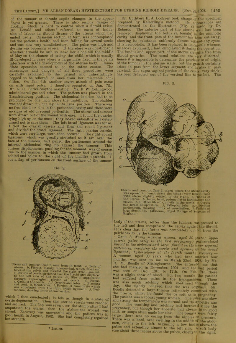 of the tumour or chronic septic changes in the appen dages is yet greater. There is also serious danger of flooding, which is hard to control when a fibroid exists. Dr. Donald and others0 referred to cases of induc- tion of labour in fibroid disease of the uterus which had ended badly. Caesarean section at term was contemplated but the patient’s health had been failing for several weeks and was now very unsatisfactory. The pulse was high and dysuria was becoming severe. It therefore was questionable whether it would be safe to leave her alone till the middle of May on the chance of saving the child, which is usually ill-developed in cases where a large mass fixed in the pelvis interferes with the development of the uterine body. Imme- diate operation seemed to be the safest course. The advantages and dangers of all three procedures were carefully explained to the patient who unhesitatingly begged to be relieved at once from her miserable con- dition. On Jan. 6th another severe attack of pain came on with rapid pulse. I therefore operated on Jan. 7th, Mr. A. C. Butler-Smythe assisting. Mr. F. W. Collingwood administered gas and ether. The patient was placed in the Trendelenburg position. The abdominal incision had to be prolonged for one inch above the umbilicus. The bladder was not drawn up but lay in its usual position. There was no free blood or clot in the peritoneal cavity and there were no signs of old or recent peritonitis. The uterus and tumour were drawn out of the wound with ease. I found the ovaries lying high up on the mass ; they looked unhealthy so I deter- mined not to save them. The left broad ligament was tense. I tied the ovarian vessels and then the round ligament and divided the broad ligament. The right ovarian vessels, which were very large, were then secured. The right round ligament, which was greatly stretched as it ran over the face of the tumour, had pulled the peritoneum around the interna] abdominal ring up against the tumour. This curious displacement, puzzling for the moment, was of course due to the manner in which the tumour had grown from behind and below to the right of the bladder upwards. I cut a flap of peritoneum on the front surface of the tumour Fig. 2. Dr. Cuthbert H. J. Lockyer took charge 0f the specimen prepared by Kaiserling's method. Its appearances are demonstrated in the illustration (Fig. 2) made by Dr. Roberts. The anterior part of the uterine wall has been removed, displaying the foetus (a female) jn the amniotic cavity, and the front part of the tumour has been cut away> showing its substance uniformly fibrous without any cysts. It is necrobiotic. It has been replaced in its capsule whence, as above explained, I had enucleated it during the operation. The fundus and upper part of the uterus are quite free from fibroid growths. The usual relations are very distorted, hence it is impossible to determine the precise site of origin of the tumour in the uterine walls, but the growth certainly arises in part from the lower segment and is also in part cervical. The supra-vaginal portion of the cervix, very thick, has been deflected out of the vertical line to the left. The Fig. 3. Caset2i seen. from in fr0Ilt- «• Body of aaa toneum, showing limits of enucleation. 1,gamont- ■>' I eri' which I then enucleated; it felt as though in a state of SSRl**r^.n7>« «» •*•*» veiel. were rlched and secured. I he flap was sewn over the stump after I had E 6 uterus- ‘eu the abdominal PWound was ?d’ Recovery was uneventful and the patient was in A“St’ 190Z- S1“> had completely regained 6 Loc. cit. Uterus and tumour, Case 3, taken before the uterine cavitv was opened to demonstrate the fcetus ; view frcrn in front with uterus slightly rotated to the right, a, Fundus of the uterus. 6, Large, hard, pedunculated fibroid above the pelvis, c, d, Other fibroids, chiefly in the cervix, e. Cervix cut across at operation. /, Fallopian tube, g, <7, Divided peritoneum, showing limits of enucleation. /i.Pedicle of large fibroid (6). (Museum, Royal College of Surgeons of England.) body of the uterus, softer than the tumour, was pressed to the left and thus compressed the cervix again.-t the fibroid. It is clear that the foetus was completely cut off from the pelvic cavity by the tumour. • Case 3. Newly married woman, aged 30 years; hypo- gastric pains early in the first pregnancy; pedunculated fibroid in the abdomen and large fibroid in the lower segment posteriorly, involving the cervix and opening up the broad ligament; hysterectomy at the. fourth month: recovery. A woman, aged 30 years, who had been married four months, was sent to me on March 22nd, 1902, by Mr. R. M. Boodle of Sittingbourne. She informed me that she had married in November, 1901, and the last period was seen on Dec. 13th to 17th. On Feb. 7th there was a slight show of blood. For two months the patient had suffered from pains in the hypogastrium There was also much retching which continued through the day She rightly believed that she was pregnant. Mr. Boodle detected a large tumour intimately connected with the uterus, whilst he found the os soft as in pregnancy, ihe patient was a robust young woman. The raise was slow and strong, the temperature was normal, and the appetite was good. Ihe vomiting and retching had increastd since the pregnancy, but though her appetite had always been good milk or soups often made her sick. The breasts were fairly large; there was no oozing from the nipples on pressure. here was a hard, oval swelling in the middle of the abdo- men, chiefly to the left, beginning a few inches above the pubes and extending almost to the left ribs. A soft body rose about three inches above the pubes, chiefly to the right.