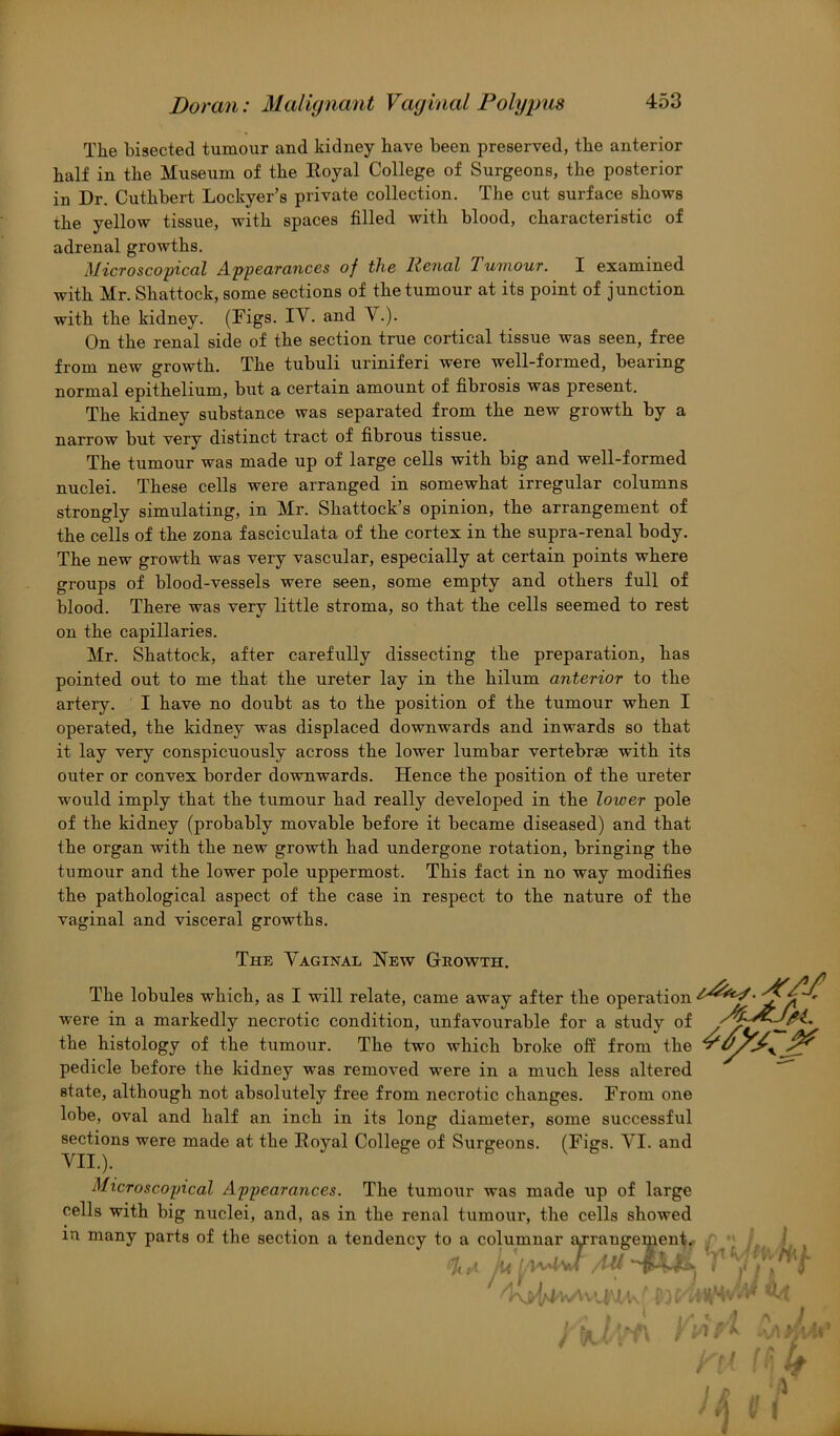 The bisected tumour and kidney have been preserved, the anterior half in the Museum of the Eoyal College of Surgeons, the posterior in Dr. Cuthbert Lockyer’s private collection. The cut surface shows the yellow tissue, with spaces filled with blood, characteristic of adrenal growths. j\IicToscopical A.pp6dTcinces of the Henol Turnout. I examined with Mr. Shattock, some sections of the tumour at its point of junction with the kidney. (Figs. IV. and V.). On the renal side of the section true cortical tissue was seen, free from new growth. The tubuli uriniferi were well-formed, bearing normal epithelium, but a certain amount of fibrosis was present. The Iddney substance was separated from the new growth by a narrow but very distinct tract of fibrous tissue. The tumour was made up of large cells with big and well-formed nuclei. These cells were arranged in somewhat irregular columns strongly simulating, in Mr. Shattock’s opinion, the arrangement of the cells of the zona fasciculata of the cortex in the supra-renal body. The new growth was very vascular, especially at certain points where groups of blood-vessels were seen, some empty and others full of blood. There was very little stroma, so that the cells seemed to rest on the capillaries. Mr. Shattock, after carefully dissecting the preparation, has pointed out to me that the ureter lay in the hilum anterior to the artery. I have no doubt as to the position of the tumour when I operated, the kidney was displaced downwards and inwards so that it lay very conspicuously across the lower lumbar vertebrae with its outer or convex border downwards. Hence the position of the ureter would imply that the tumour had really developed in the lower pole of the kidney (probably movable before it became diseased) and that the organ with the new growth had undergone rotation, bringing the tumour and the lower pole uppermost. This fact in no way modifies the pathological aspect of the case in respect to the nature of the vaginal and visceral growths. The Vaginal New Growth. The lobules which, as I will relate, came away after the operation were in a markedly necrotic condition, unfavourable for a study of the histology of the tumour. The two which broke off from the pedicle before the kidney was removed were in a much less altered state, although not absolutely free from necrotic changes. From one lobe, oval and half an inch in its long diameter, some successful sections were made at the Royal College of Surgeons. (Figs. VI. and Microscopical Appearances. The tumour was made up of large cells with big nuclei, and, as in the renal tumour, the cells showed in many parts of the section a tendency to a columnar arrangement. , ( /l-li ''■y'— .'X; ■k