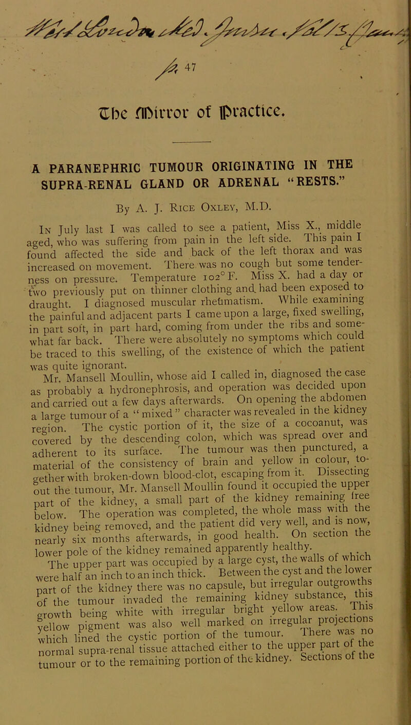 ^be flDirror of ipiactice. A PARANEPHRIC TUMOUR ORIGINATING IN THE SUPRARENAL GLAND OR ADRENAL “RESTS.” By A. J. Rice Oxley, M.D. In July last I was called to see a patient, Miss X., middle aged, who was suffering from pain in the left side. This pain I found affected the side and back of the left thorax and was increased on movement. There was no cough but some tender- ness on pressure. Temperature 102° F. Miss X. had a day or two previously put on thinner clothing and. had been exposed to draught. I diagnosed muscular rhetimatism. While examining the painful and adjacent parts I came upon a large, fixed swelling, in part soft, in part hard, coming from under the ribs and some- what far back. There were absolutely no symptoms which could be traced to this swelling, of the existence of which the patient was quite ignorant. Mr Mansell Moullin, whose aid I called in, diagnosed the case as probably a hydronephrosis, and operation wp decided upon and carried out a few days afterwards. On opening the abdomen a large tumour of a “ mixed ” character was revealed in the kidney region. The cystic portion of it, the size of a cocoanut, was covered by the descending colon, which was spread over and adherent to its surface. The tumour was then punctured, a material of the consistency of brain and yellow in colour, to- gether with broken-down blood-clot, escaping from it. Dissecting out the tumour, Mr. Mansell Moullin found it occupied the upper part of the kidney, a small part of the kidney remaining free below The operation was completed, the whole mass with the kidney being removed, and the patient did very well, and is now, nearly six months afterwards, in good health. On section the lower pole of the kidney remained apparently healthy. The upper part was occupied by a large cyst, the walls o w were half an inch to an inch thick. Between the cyst and the lower part of the kidney there was no capsule, but irregular outgrow-ths of the tumour invaded the remaining kidney substance, th s growth being white with irregular bright yellow areas. Th yellow pigment was also well marked on irregular projections which lined the cystic portion of the tumour. Ihere was no normal supra-renal tissue attached either to the upper part of the tumour or to the remaining portion of the kidney. Sections of tl e