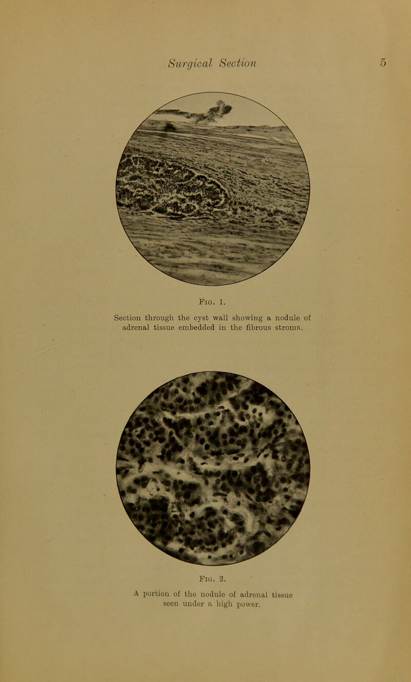 Fig. 1. Section through the cyst wall showing a nodule of adrenal tissue embedded in the fibrous stroma. Fig. 2. A portion of the nodule of adrenal tissue seen under a high power.