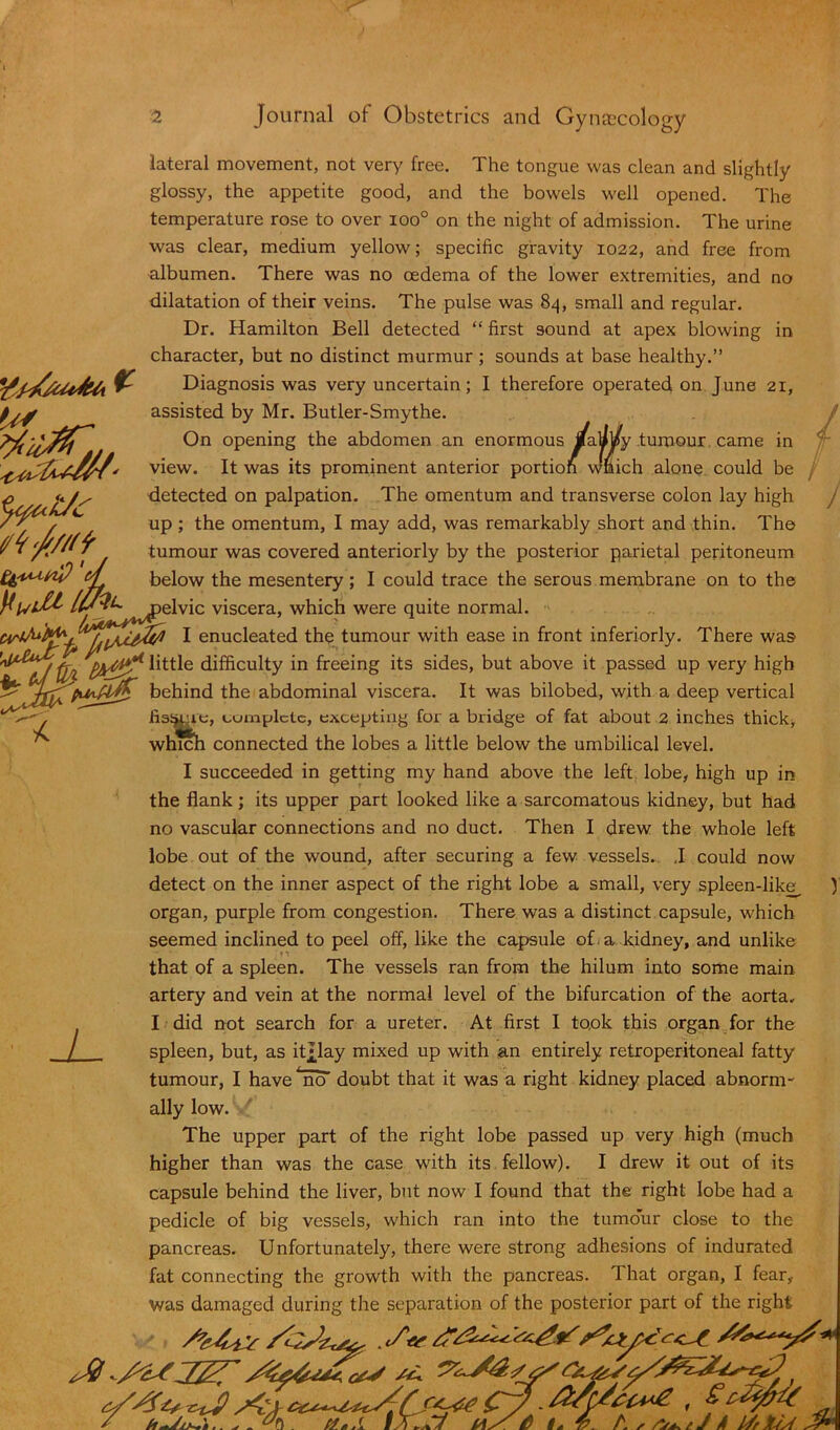 U* fifo/tf ypAsLni? d lateral movement, not very free. The tongue was clean and slightly glossy, the appetite good, and the bowels well opened. The temperature rose to over ioo° on the night of admission. The urine was clear, medium yellow; specific gravity 1022, and free from albumen. There was no cedema of the lower extremities, and no dilatation of their veins. The pulse was 84, small and regular. Dr. Hamilton Bell detected “ first sound at apex blowing in character, but no distinct murmur ; sounds at base healthy.” Diagnosis was very uncertain; I therefore operated on June 21, assisted by Mr. Butler-Smythe. On opening the abdomen an enormous /aajpy tumour came in view. It was its prominent anterior portion w'nich alone could be detected on palpation. The omentum and transverse colon lay high up ; the omentum, I may add, was remarkably short and thin. The tumour was covered anteriorly by the posterior parietal peritoneum below the mesentery ; I could trace the serous membrane on to the viscera, which were quite normal I enucleated the tumour with ease in front interiorly. There was little difficulty in freeing its sides, but above it passed up very high behind the abdominal viscera. It was bilobed, with a deep vertical fissile, complete, excepting fox a bridge of fat about 2 inches thick, which connected the lobes a little below the umbilical level. I ) I succeeded in getting my hand above the left lobe, high up in the flank; its upper part looked like a sarcomatous kidney, but had no vascular connections and no duct. Then I drew the whole left lobe out of the wound, after securing a few vessels. J could now detect on the inner aspect of the right lobe a small, very spleen-like organ, purple from congestion. There was a distinct capsule, which seemed inclined to peel off, like the capsule of. a kidney, and unlike that of a spleen. The vessels ran from the hilum into some main artery and vein at the normal level of the bifurcation of the aorta. I did not search for a ureter. At first I took this organ for the spleen, but, as itjjay mixed up with an entirely retroperitoneal fatty tumour, I have no- doubt that it was a right kidney placed abnorm- ally low. The upper part of the right lobe passed up very high (much higher than was the case with its fellow). I drew it out of its capsule behind the liver, but now I found that the right lobe had a pedicle of big vessels, which ran into the tumour close to the pancreas. Unfortunately, there were strong adhesions of indurated fat connecting the growth with the pancreas. That organ, I fear, was damaged during the separation of the posterior part of the right