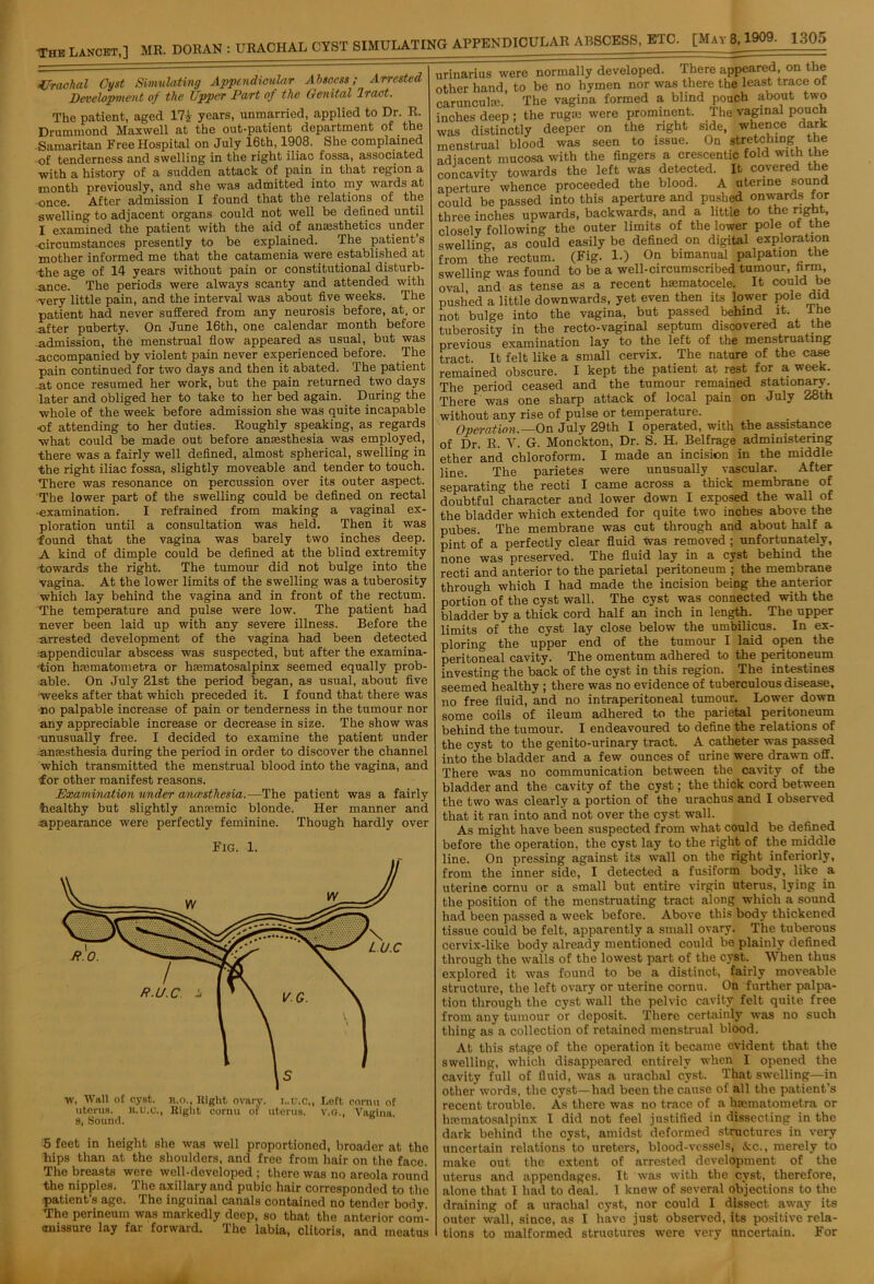 Urachal Cyst Simulating Appendicular Abscess; Arrested Development of the Upper Part of the Genital 'lract. The patient, aged 17£- years, unmarried, applied to Dr. R. Drummond Maxwell at the out-patient department of the Samaritan Free Hospital on July 16th, 1908. She complained of tenderness and swelling in the right iliac fossa, associated with a history of a sudden attack of pain in that region a month previously, and she was admitted into my wards at once. After admission I found that the relations of the swelling to adjacent organs could not well be defined until I examined the patient with the aid of anesthetics under circumstances presently to be explained. The patient’s mother informed me that the catamenia were established at the age of 14 years without pain or constitutional disturb- ance.0 The periods were always scanty and attended with very little pain, and the interval was about five weeks. The patient had never suffered from any neurosis before, at, or after puberty. On June 16th, one calendar month before admission, the menstrual flow appeared as usual, but was accompanied by violent pain never experienced before. The pain continued for two days and then it abated. The patient at once resumed her work, but the pain returned two days later and obliged her to take to her bed again. During the whole of the week before admission she was quite incapable •of attending to her duties. Roughly speaking, as regards what could be made out before anaesthesia was employed, there was a fairly well defined, almost spherical, swelling in the right iliac fossa, slightly moveable and tender to touch. There was resonance on percussion over its outer aspect. The lower part of the swelling could be defined on rectal •examination. I refrained from making a vaginal ex- ploration until a consultation was held. Then it was •found that the vagina was barely two inches deep. A kind of dimple could be defined at the blind extremity •towards the right. The tumour did not bulge into the vagina. At the lower limits of the swelling was a tuberosity which lay behind the vagina and in front of the rectum. The temperature and pulse were low. The patient had never been laid up with any severe illness. Before the ■arrested development of the vagina had been detected ■appendicular abscess was suspected, but after the examina- tion hrematometra or htematosalpinx seemed equally prob- able. On July 21st the period began, as usual, about five weeks after that which preceded it. I found that there was no palpable increase of pain or tenderness in the tumour nor any appreciable increase or decrease in size. The show was ■■unusually free. I decided to examine the patient under anaesthesia during the period in order to discover the channel which transmitted the menstrual blood into the vagina, and for other manifest reasons. Examination under ancesthesia.—The patient was a fairly healthy but slightly anaemic blonde. Her manner and appearance were perfectly feminine. Though hardly over Fig. 1. W, Wall of cyst. R.o., Right ovary. I..U.C,, Left cornu of uterus. K.u.c., Right cornu of uterus. V.G., Vagina, s, Sound. 5 feet in height she was well proportioned, broader at the hips than at the shoulders, and free from hair on the face. The breasts were well-developed ; there was no areola round the nipples. The axillary and pubic hair corresponded to the patient’s age. The inguinal canals contained no tender body The perineum was markedly deep, so that the anterior com- missure lay far forward. The labia, clitoris, and meatus urinarius were normally developed. There appeared on the other hand, to be no hymen nor was there the least trace of caruncukc. The vagina formed a blind pouch about two inches deep ; the rug;c were prominent. The vaginal pouch was distinctly deeper on the right side, whence dark menstrual blood was seen to issue. On stretching the adiacent mucosa with the fingers a crescentic fold with the concavity towards the left was detected. It covered the aperture’ whence proceeded the blood. A uterine sound could be passed into this aperture and pushed onwards for three inches upwards, backwards, and a little to the right, closely following the outer limits of the lower pole of the swelling, as could easily be defined on digital exploration from the rectum. (Fig. 1.) On bimanual palpation the swelling was found to be a well-circumscribed tumour, firm, oval, and as tense as a recent haematocele. It could be pushed a little downwards, yet even then its lower pole did not bulge into the vagina, but passed behind it. ihe tuberosity in the recto-vaginal septum discovered at the previous examination lay to the left of the menstruating tract. It felt like a small cervix. The nature of the case remained obscure. I kept the patient at rest for a week. The period ceased and the tumour remained stationary. There was one sharp attack of local pain on July 28th without any rise of pulse or temperature. Operation.—On July 29th I operated, with the assistance of Dr. R. V. G. Monckton, Dr. S. H. Belfrage administering ether and chloroform. I made an incision in the middle line. The parietes were unusually vascular. After separating the recti I came across a thick membrane of doubtful 'character and lower down I exposed the wall of the bladder which extended for quite two inches above the pubes. The membrane was cut through and about half a pint of a perfectly clear fluid was removed ; unfortunately, none was preserved. The fluid lay in a cyst behind the recti and anterior to the parietal peritoneum ; the membrane through which I had made the incision being the anterior portion of the cyst wall. The cyst was connected with the bladder by a thick cord half an inch in length. The upper limits of the cyst lay close below the umbilicus. In ex- ploring the upper end of the tumour I laid open the peritoneal cavity. The omentum adhered to the peritoneum investing the back of the cyst in this region. The intestines seemed healthy ; there was no evidence of tuberculous disease, no free fluid, and no intraperitoneal tumour. Lower down some coils of ileum adhered to the parietal peritoneum behind the tumour. I endeavoured to define the relations of the cyst to the genito-urinary tract. A catheter was passed into the bladder and a few ounces of urine were drawn off. There was no communication between the cavity of the bladder and the cavity of the cyst; the thick cord between the two was clearly a portion of the urachus and I observed that it ran into and not over the cyst wall. As might have been suspected from what could be defined before the operation, the cyst lay to the right of the middle line. On pressing against its wall on the right inferiorly, from the inner side, I detected a fusiform body, like a uterine cornu or a small but entire virgin uterus, lying in the position of the menstruating tract along which a sound had been passed a week before. Above this body thickened tissue could be felt, apparently a small ovary. The tuberous cervix-like body already mentioned could be plainly defined through the walls of the lowest part of the cyst. When thus explored it was found to be a distinct, fairly moveable structure, the left ovary or uterine cornu. On further palpa- tion through the cyst wall the pelvic cavity felt quite free from any tumour or deposit. There certainly was no such t.hinor ns n collection of retained menstrual blood. At this stage of the operation it became evident that the swelling, which disappeared entirely when I opened the cavity full of fluid, was a urachal cyst. That swelling—in other words, the cyst—had been the cause of all the patient’s recent trouble. As there was no trace of a hmmatometra or luematosalpinx I did not feel justified in dissecting in the dark behind the cyst, amidst deformed structures in very uncertain relations to ureters, blood-vessels, &c., merely to make out the extent of arrested development of the uterus and appendages. It was with the cyst, therefore, alone that I had to deal. 1 knew of several objections to the draining of a urachal cyst, nor could I dissect away its outer wall, since, as I have just observed, its positive rela- tions to malformed structures were very uncertain. For