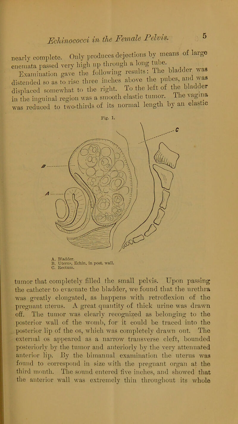 Echinococci in the Eenude 1 clots. nearly complete. Only produces dejections by means of large enemata passed very high up through a long tii 1 ,e' Examination gave the following results. ie > 1 distended so as to rise three inches above the pubes, and was displaced somewhat to the right. To the left of the bladder in the inguinal region was a smooth elastic tumoi. ie vagina was reduced to two-thirds of its normal length by an elastic A. Bladder. B. Uterus, Echin. in post. wall. C. Bectum. tumor that completely filled the small pelvis. Upon passing the catheter to evacuate the bladder, we found that the urethra was greatly elongated, as happens with retroflexion of the pregnant uterus. A great quantity of thick urine was drawn off. The tumor was clearly recognized as belonging to the posterior wall of the womb, for it could be traced into the posterior lip of the os, which was completely drawn out. The external os appeared as a narrow transverse cleft, bounded posteriorly by the tumor and anteriorly by the very attenuated anterior lip. J>y the bimanual examination the uterus was found to correspond in size with the pregnant organ at. the third month. The sound entered live inches, and showed that the anterior wall was extremely thin throughout its whole