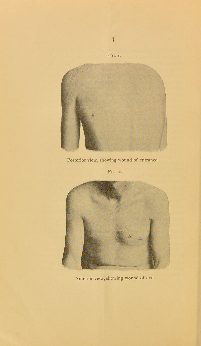 Fig. i. Posterior view, showing wound of entrance. Fig. 2. Anterior view, showing wound of exit.