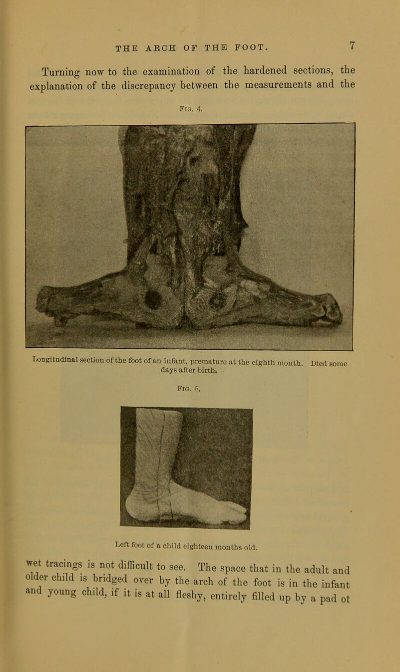 Turning now to the examination of the hardened sections, the explanation of the discrepancy between the measurements and the Fro. A. Longitudinal section of the foot of an infant, premature at the eighth month. Died some days after hirth. Fig. Left foot of a child eighteen months old. wet tracings is not difficult to see. The space that in the adult and older child is bridged over by the arch of the foot is in the infant and young child, if it is at all fleshy, entirely filled up by a pad ot