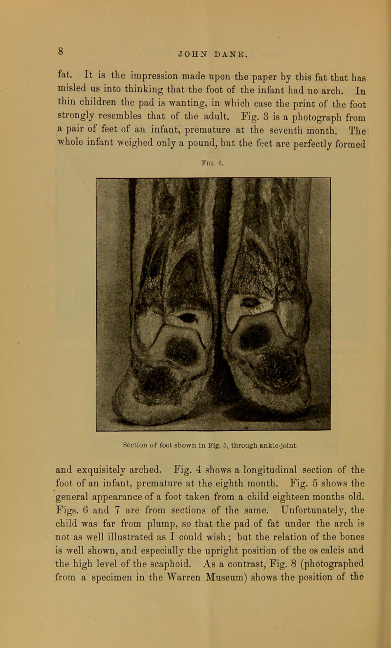 fat. It is the impression made upon the paper by this fat that has misled us into thinking that the foot of the infant had no arch. In thin children the pad is wanting, in which case the print of the foot strongly resembles that of the adult. Fig* 3 is a photograph from a pair of feet of an infant, premature at the seventh month. The whole infant weighed only a pound, but the feet are perfectly formed Fig. 6. Section of foot shown in Fig. 5, through ankle-joint. and exquisitely arched. Fig. 4 shows a longitudinal section of the foot of an infant, premature at the eighth month. Fig. 5 shows the general appearance of a foot taken from a child eighteen months old. Figs. 6 and 7 are from sections of the same. Unfortunately, the child was far from plump, so that the pad of fat under the arch is not as well illustrated as I could wish ; but the relation of the bones is well shown, and especially the upright position of the os calcis and the high level of the scaphoid. As a contrast, Fig. 8 (photographed from a specimen in the Warren Museum) shows the position of the