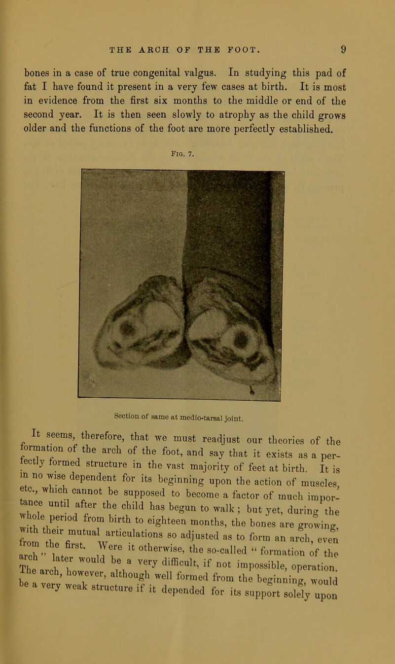 bones in a case of true congenital valgus. In studying this pad of fat I have found it present in a very few cases at birth. It is most in evidence from the first six months to the middle or end of the second year. It is then seen slowly to atrophy as the child grows older and the functions of the foot are more perfectly established. Fig. 7. bection oi same at medio-tarsal joint. It seems, therefore, that we must readjust our theories of the formation of the arch of the foot, and say that it exists as a per- fectly formed structure in the vast majority of feet at birth. It is m no wise dependent for its beginning upon the action of muscles, etc., which cannot be supposed to become a factor of much impor- tance until after the child has begun to walk; but yet, during the w ole period from birth to eighteen months, the bones are growing, from thTfi”?” wrti0UlatirS 80 adiuated ”s t0 f0™ “ ««l>. -on arch ” I t® , Te “ othenv,se- *e so-called “ formation of the -eh later would be a very difficult, if not impossible, operation Ihe arch, however, although well formed from the beginning w “hi be a very weak structure if it depended for its support solely upon