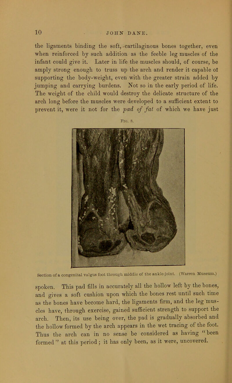 the ligaments binding the soft, cartilaginous bones together, even when reinforced by such addition as the feeble leg muscles of the infant could give it. Later in life the muscles should, of course, be amply strong enough to truss up the arch and render it capable ot supporting the body-weight, even with the greater strain added by jumping and carrying burdens. Not so in the early period of life. The weight of the child would destroy the delicate structure of the arch long before the muscles were developed to a sufficient extent to prevent it, were it not for the pad of fat of which we have just Fin. 8. Section of a congenital valgus foot through middle of the ankle-joint. (Warren Museum.) spoken. This pad fills in accurately all the hollow left by the bones, and gives a soft cushion upon which the bones rest until such time as the bones have become hard, the ligaments firm, and the leg mus- cles have, through exercise, gained sufficient strength to support the arch. Then, its use being over, the pad is gradually absorbed and the hollow formed by the arch appears in the wet tracing ot the foot. Thus the arch can in no sense be considered as having been formed ’’ at this period ; it has only been, as it were, uncovered.