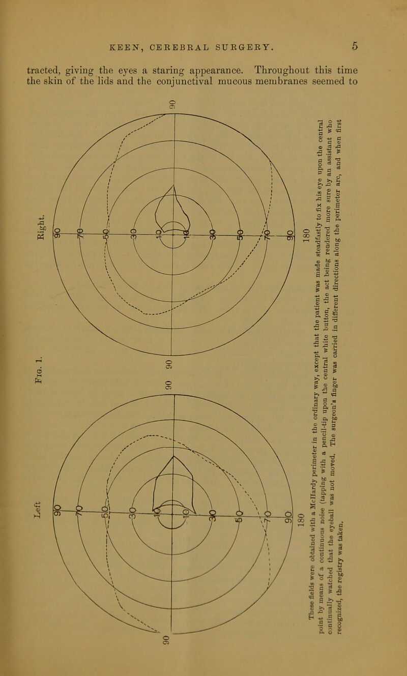 tracted, giving the eyes a staring appearance. Throughout this time the skin of the lids and the conjunctival mucous membranes seemed to