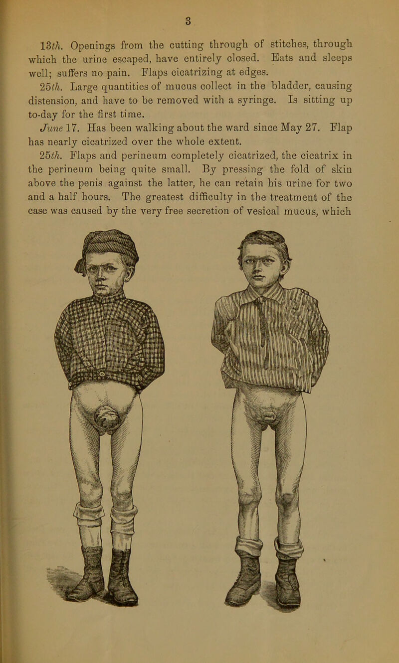 13*A. Openings from the cutting through of stitches, through which the urine escaped, have entirely closed. Eats and sleeps well; suffers no pain. Flaps cicatrizing at edges. 25t.li. Large quantities of mucus collect in the bladder, causing distension, and have to be removed with a syringe. Is sitting up to-day for the first time. June 17. Has been walking about the ward since May 27. Flap has nearly cicatrized over the whole extent. 25th. Flaps and perineum completely cicatrized, the cicatrix in the perineum being quite small. By pressing the fold of skin above the penis against the latter, he can retain his urine for two and a half hours. The greatest difficulty in the treatment of the case was caused by the very free secretion of vesical mucus, which