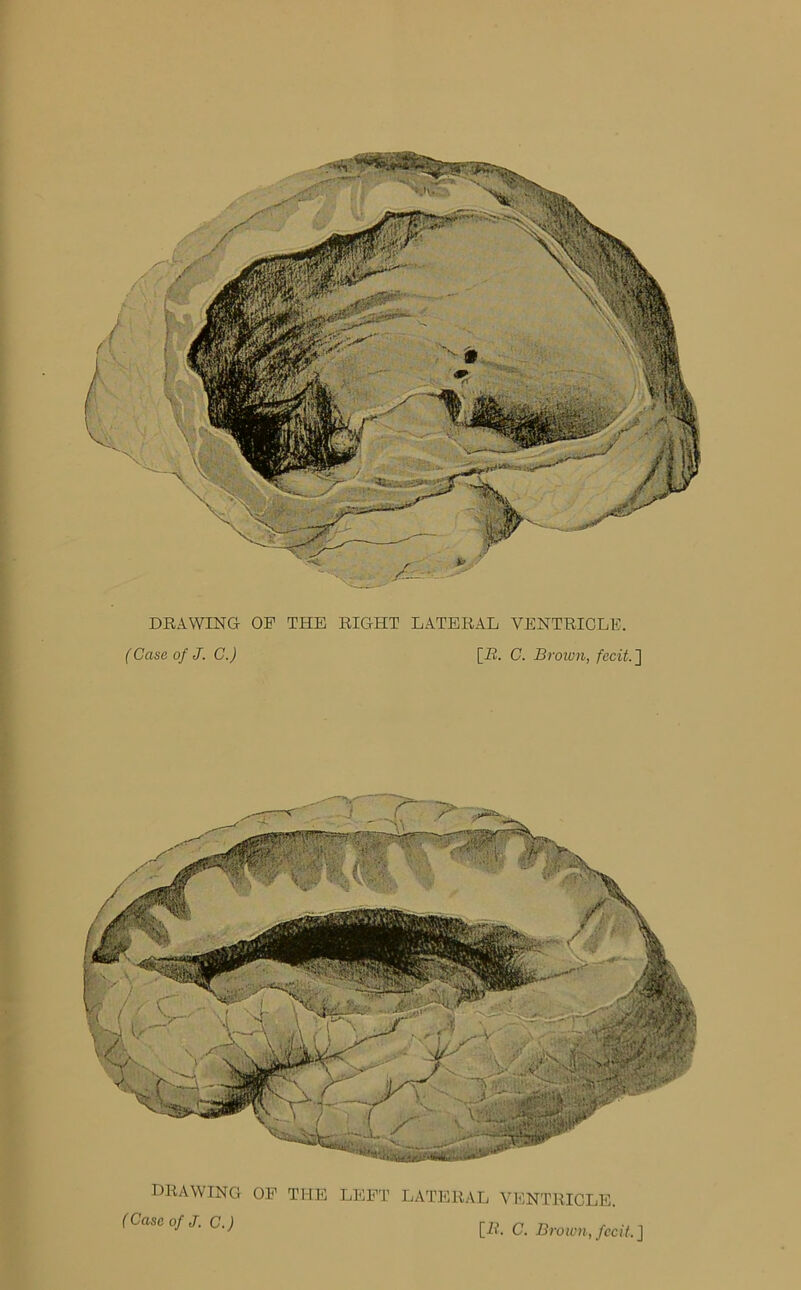 DRAWING OP THE RIGHT LATERAL VENTRICLE. (Case of J. C.) [H. C. Brown, fecit.] DRAWING (Case of J. C.) OP THE LEFT LATERAL VENTRICLE. [-R. C. Brown, fecit. J