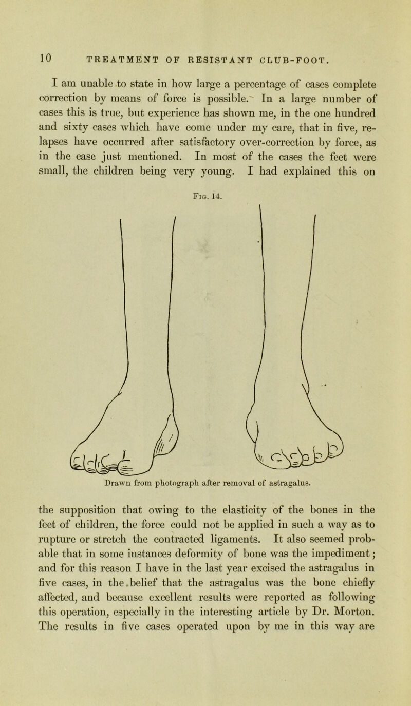 I am unable .to state in how large a percentage of cases complete correction by means of force is possible. In a large number of cases this is true, but experience has shown me, in the one hundred and sixty cases which have come under my care, that in five, re- lapses have occurred after satisfactory over-correction by force, as in the case just mentioned. In most of the cases the feet were small, the children being very young. I had explained this on Fie. 14. Drawn from photograph after removal of astragalus. the supposition that owing to the elasticity of the bones in the feet of children, the force could not be applied in such a way as to rupture or stretch the contracted ligaments. It also seemed prob- able that in some instances deformity of bone was the impediment; and for this reason I have in the last year excised the astragalus in five cases, in the.belief that the astragalus was the bone chiefly affected, and because excellent results were reported as following this operation, especially in the interesting article by Dr. Morton. The results in five cases operated upon by me in this way are
