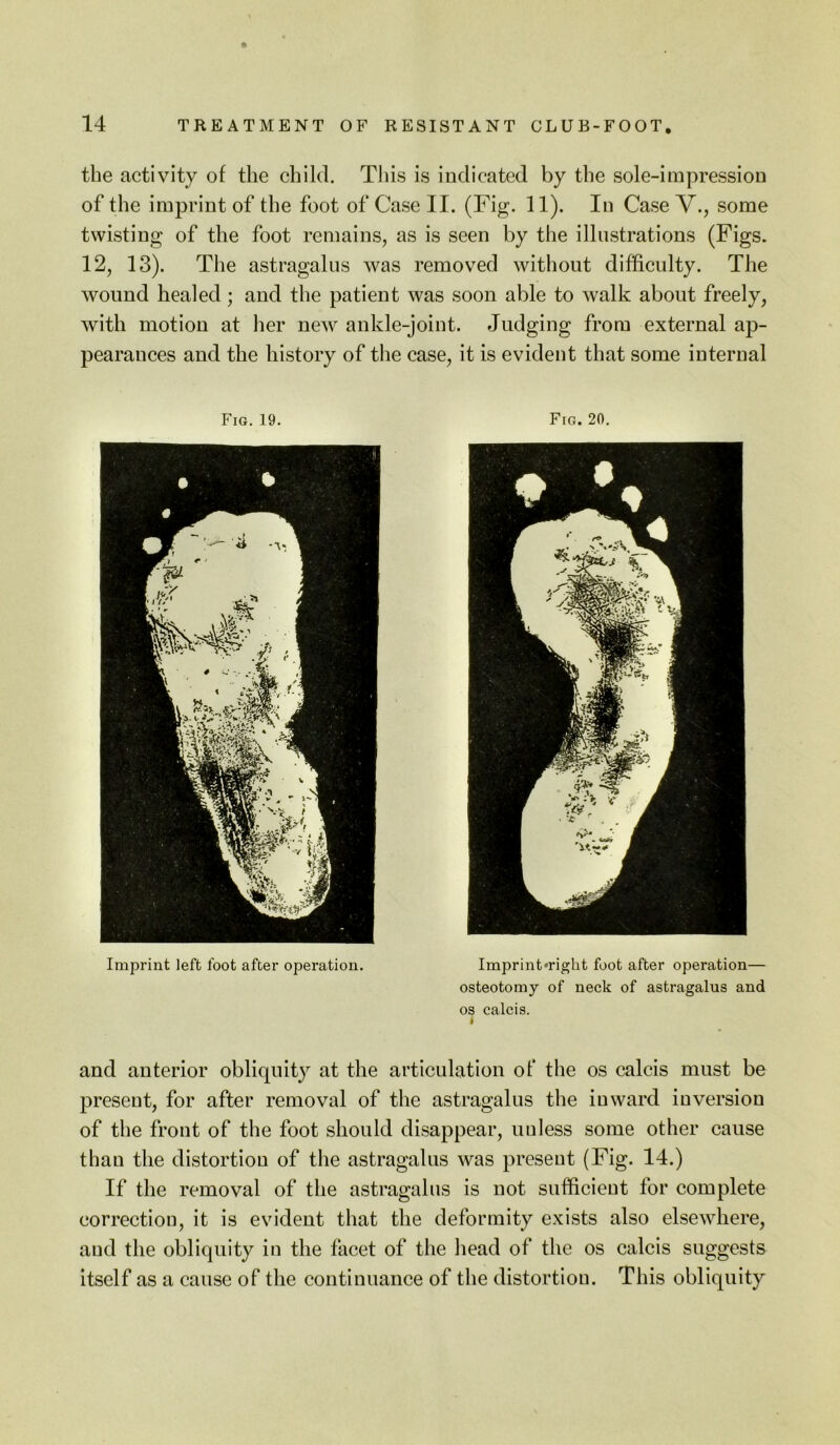 the activity of the child. This is indicated by the sole-impression of the imprint of the foot of Case II. (Fig. 11). In Case V., some twisting of the foot remains, as is seen by the illustrations (Figs. 12, 13). The astragalus was removed without difficulty. The wound healed; and the patient was soon able to walk about freely, with motion at her new ankle-joint. Judging from external ap- pearances and the history of the case, it is evident that some internal Fig, 19. Fig. 20. Imprint left foot after operation. Imprint*right foot after operation— osteotomy of neck of astragalus and os calcis. » and anterior obliquity at the articulation of the os calcis must be present, for after removal of the astragalus the inward inversion of the front of the foot should disappear, unless some other cause than the distortion of the astragalus was present (Fig. 14.) If the removal of the astragalus is not sufificieut for complete correction, it is evident that the deformity exists also elsewhere, and the obliquity in the facet of the head of the os calcis suggests itself as a cause of the continuance of the distortion. This obliquity