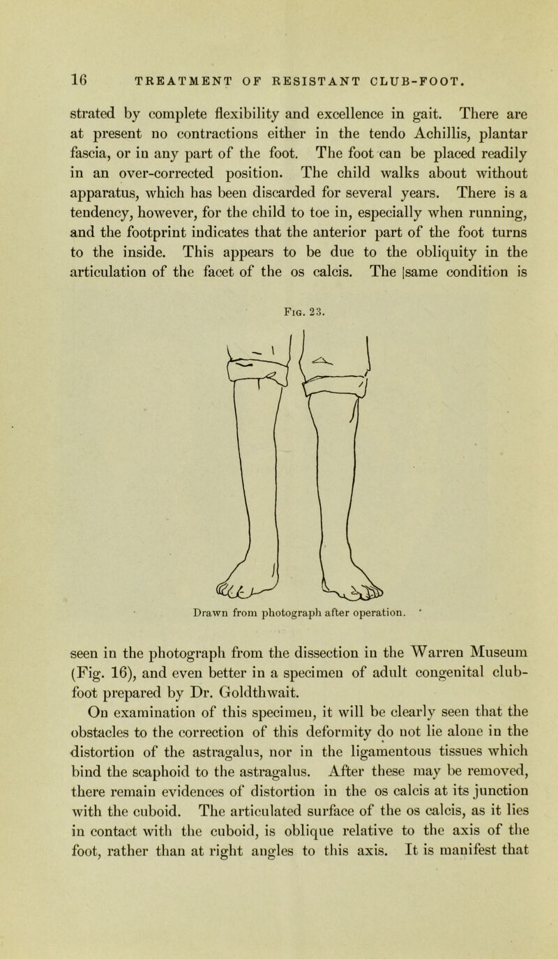 strated by complete flexibility and excellence in gait. There are at present no contractions either in the tendo Achillis, plantar fascia, or in any part of the foot. The foot can be placed readily in an over-corrected position. The child walks about without apparatus, which has been discarded for several years. There is a tendency, however, for the child to toe in, especially when running, and the footprint indicates that the anterior part of the foot turns to the inside. This appears to be due to the obliquity in the articulation of the facet of the os calcis. The [same condition is Fig. 23. Drawn from photograph after operation. seen in the photograph from the dissection in the Warren Museum (Fig. 16), and even better in a specimen of adult congenital club- foot prepared by Dr. Goldthwait. On examination of this specimen, it will be clearly seen that the obstacles to the correction of this deformity do not lie alone in the distortion of the astragalus, nor in the ligamentous tissues which bind the scaphoid to the astragalus. After these may be removed, there remain evidences of distortion in the os calcis at its junction with the cuboid. The articulated surface of the os calcis, as it lies in contact with the cuboid, is oblique relative to the axis of the foot, rather than at right angles to this axis. It is manifest that